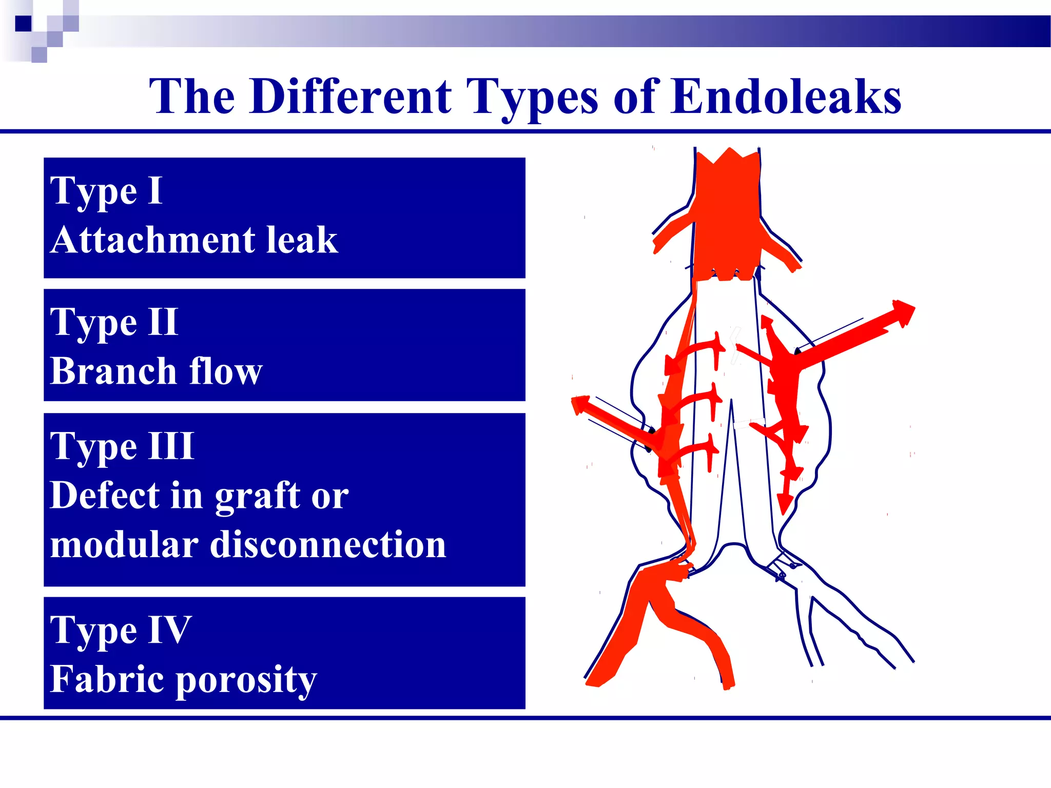 Type I
Attachment leak
Type II
Branch flow
Type III
Defect in graft or
modular disconnection
Type IV
Fabric porosity
The Different Types of Endoleaks
 