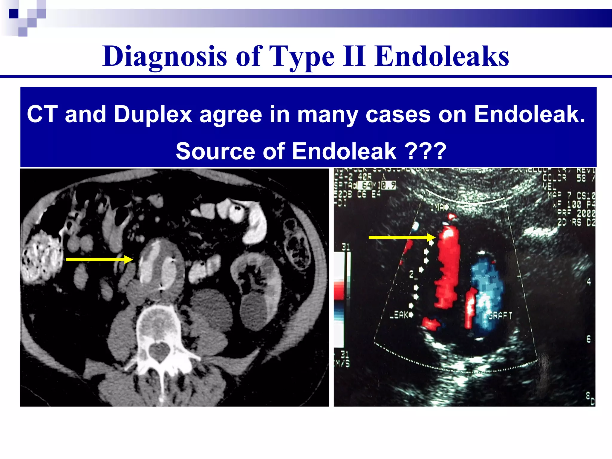 Diagnosis of Type II Endoleaks
CT and Duplex agree in many cases on Endoleak.
Source of Endoleak ???
 