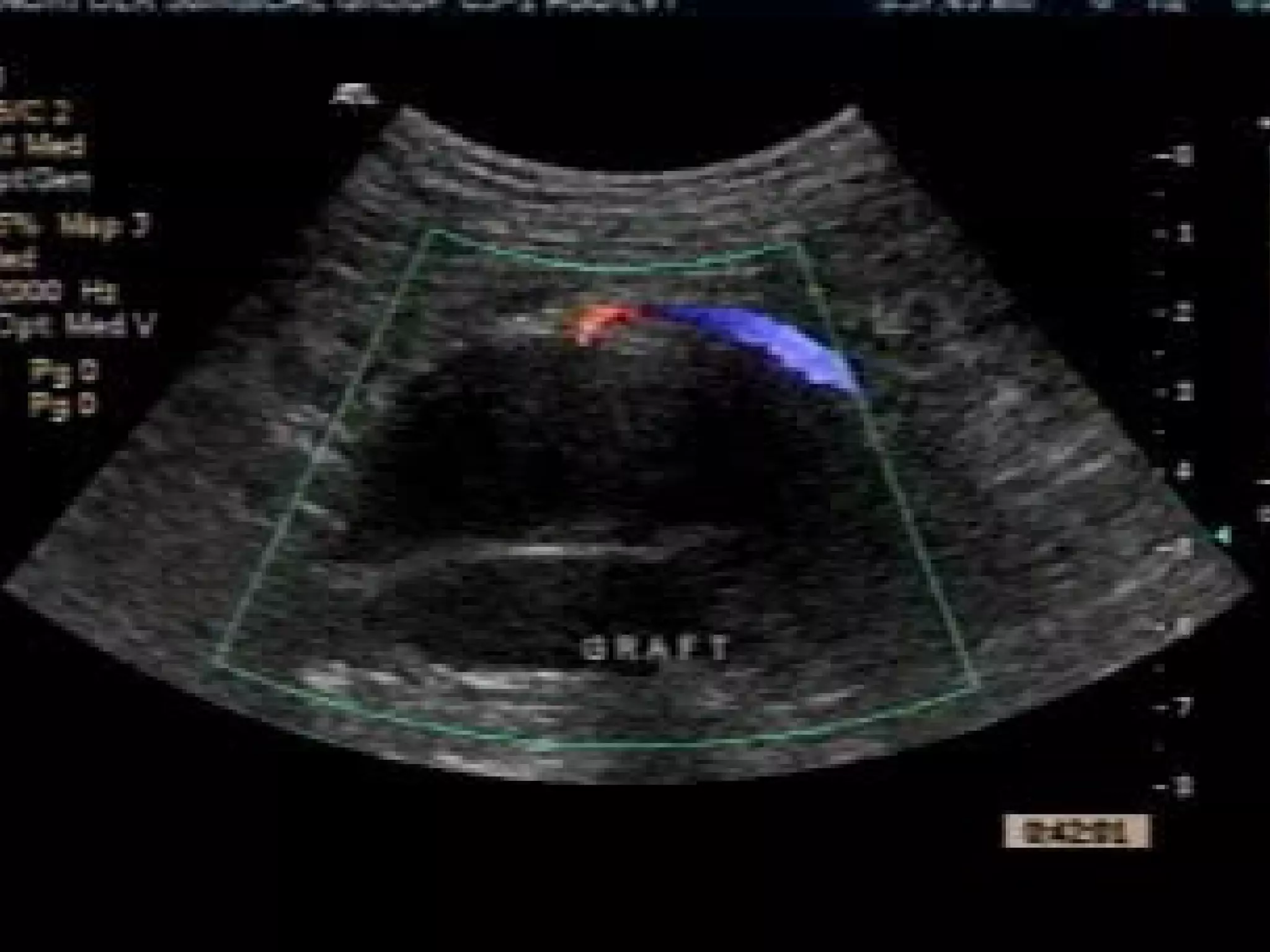 Diagnosis of Type II Endoleaks
 