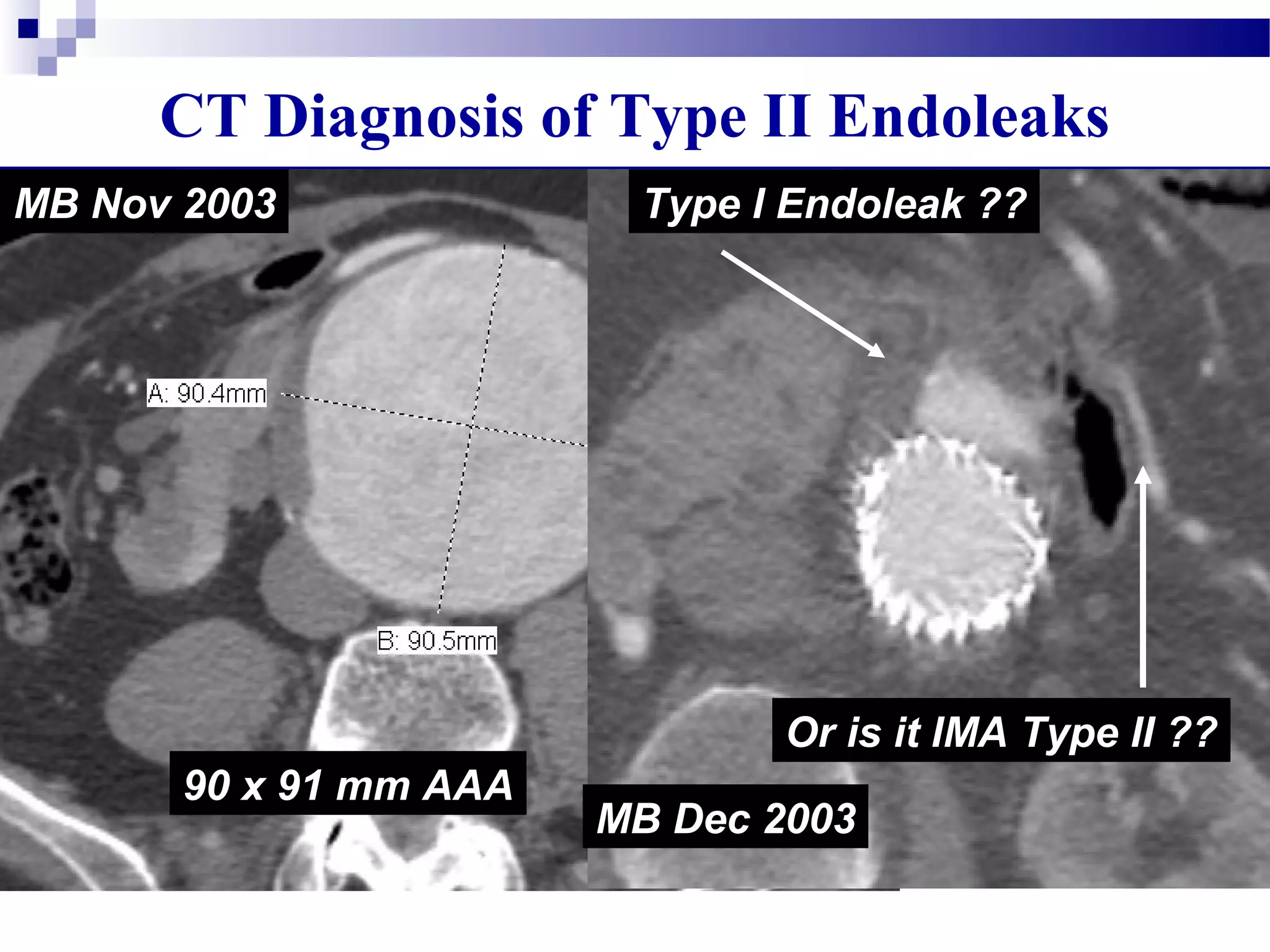  Source can be difficult to determine
 Some endoleaks are very complex
90 x 91 mm AAA
MB Nov 2003
MB Dec 2003
Type I Endoleak ??
Or is it IMA Type II ??
CT Diagnosis of Type II Endoleaks
 