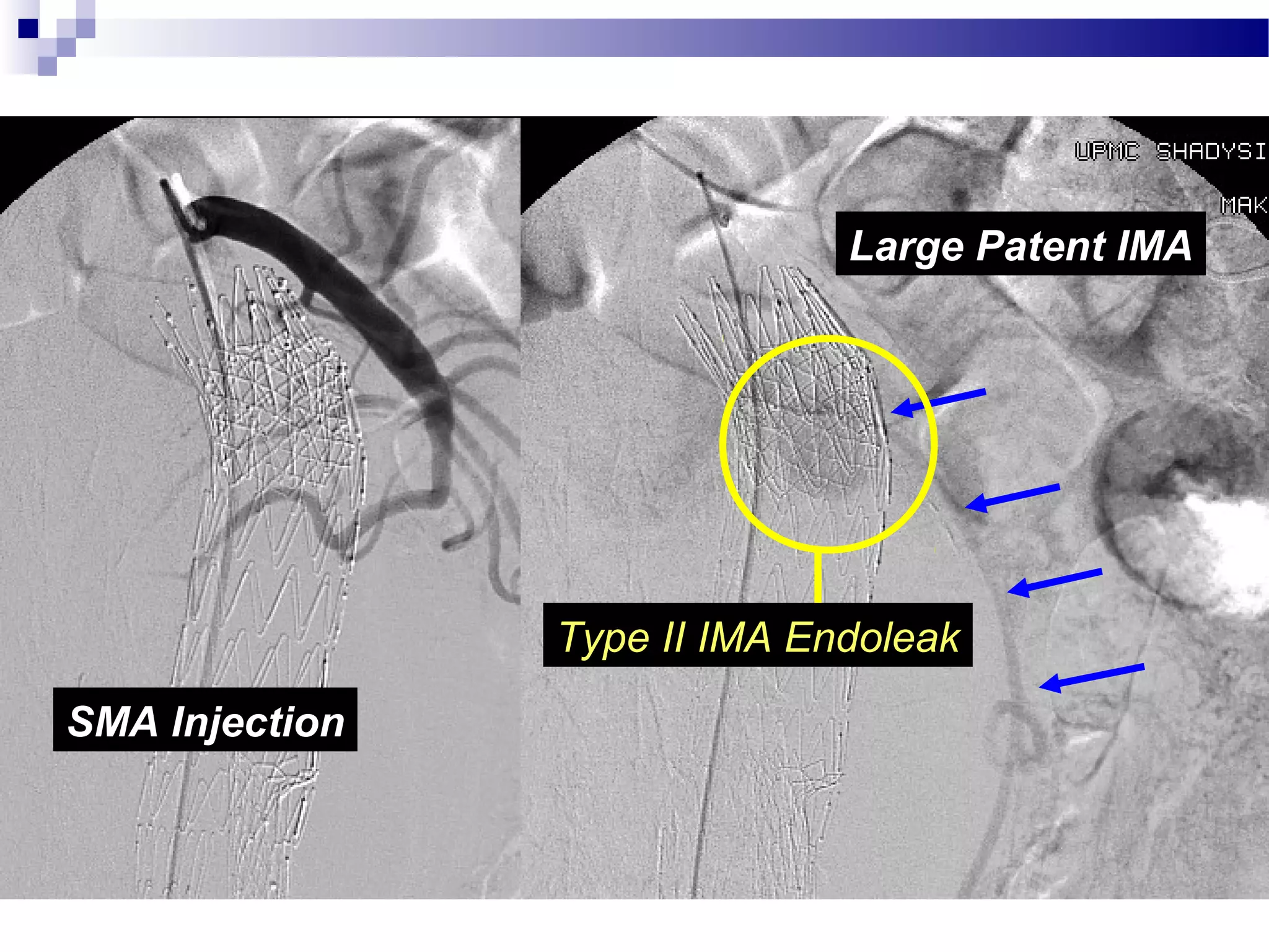 SMA Injection
Large Patent IMA
Type II IMA Endoleak
 