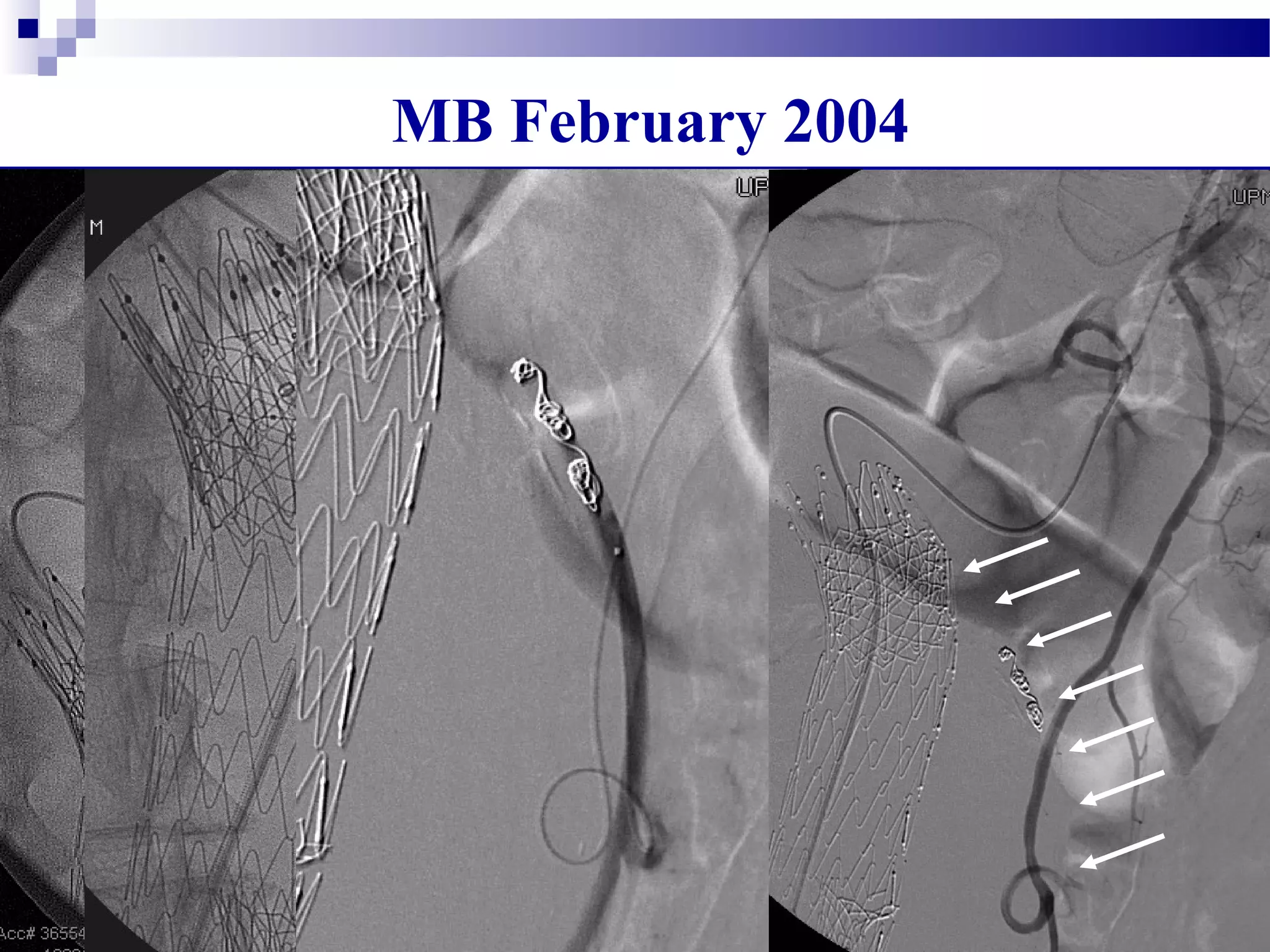 MB February 2004
5 Fr Glide cath
Renegade
Microcath
Transcend
.014 wire
 