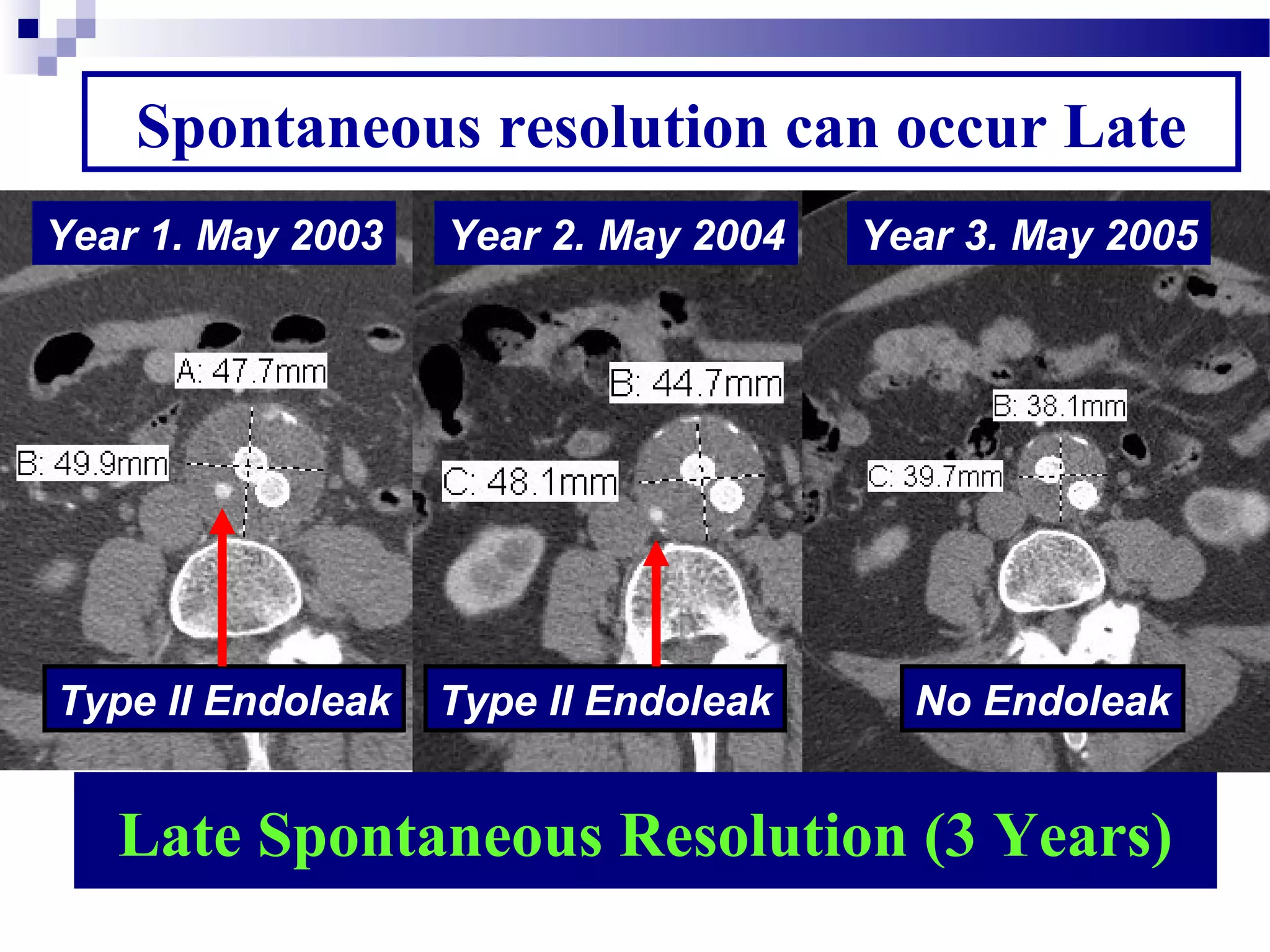 Spontaneous resolution can occur Late
Year 1. May 2003
Type II Endoleak
Year 2. May 2004
Type II Endoleak
Year 3. May 2005
No Endoleak
Late Spontaneous Resolution (3 Years)
 
