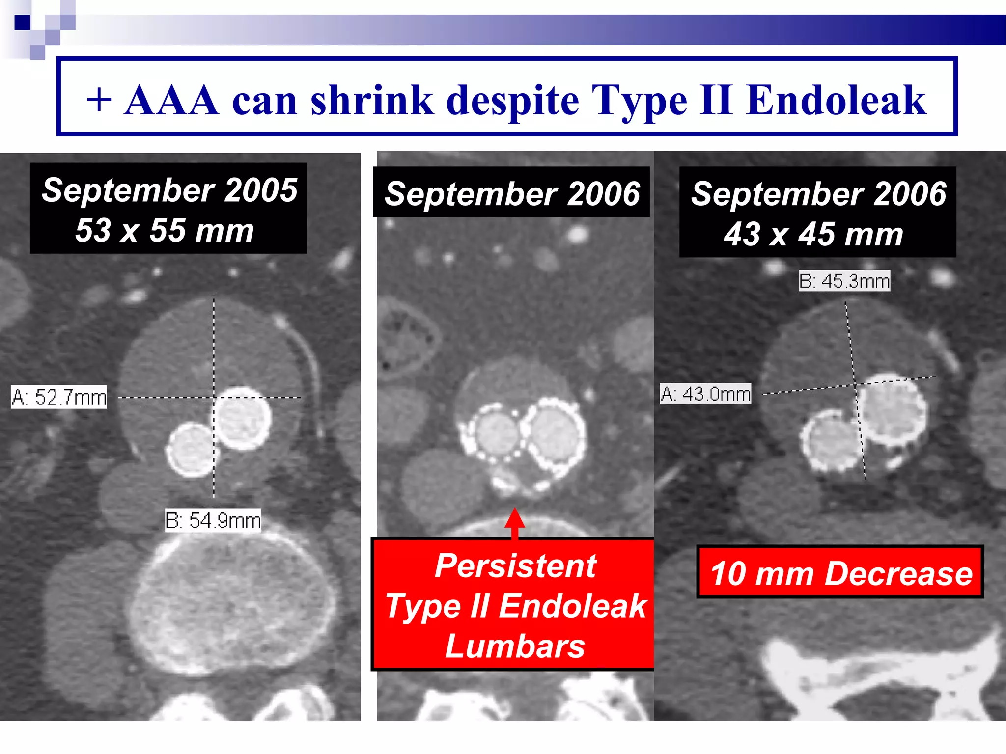 Persistent
Type II Endoleak
Lumbars
September 2006
+ AAA can shrink despite Type II Endoleak
September 2005
53 x 55 mm
September 2006
43 x 45 mm
10 mm Decrease
 