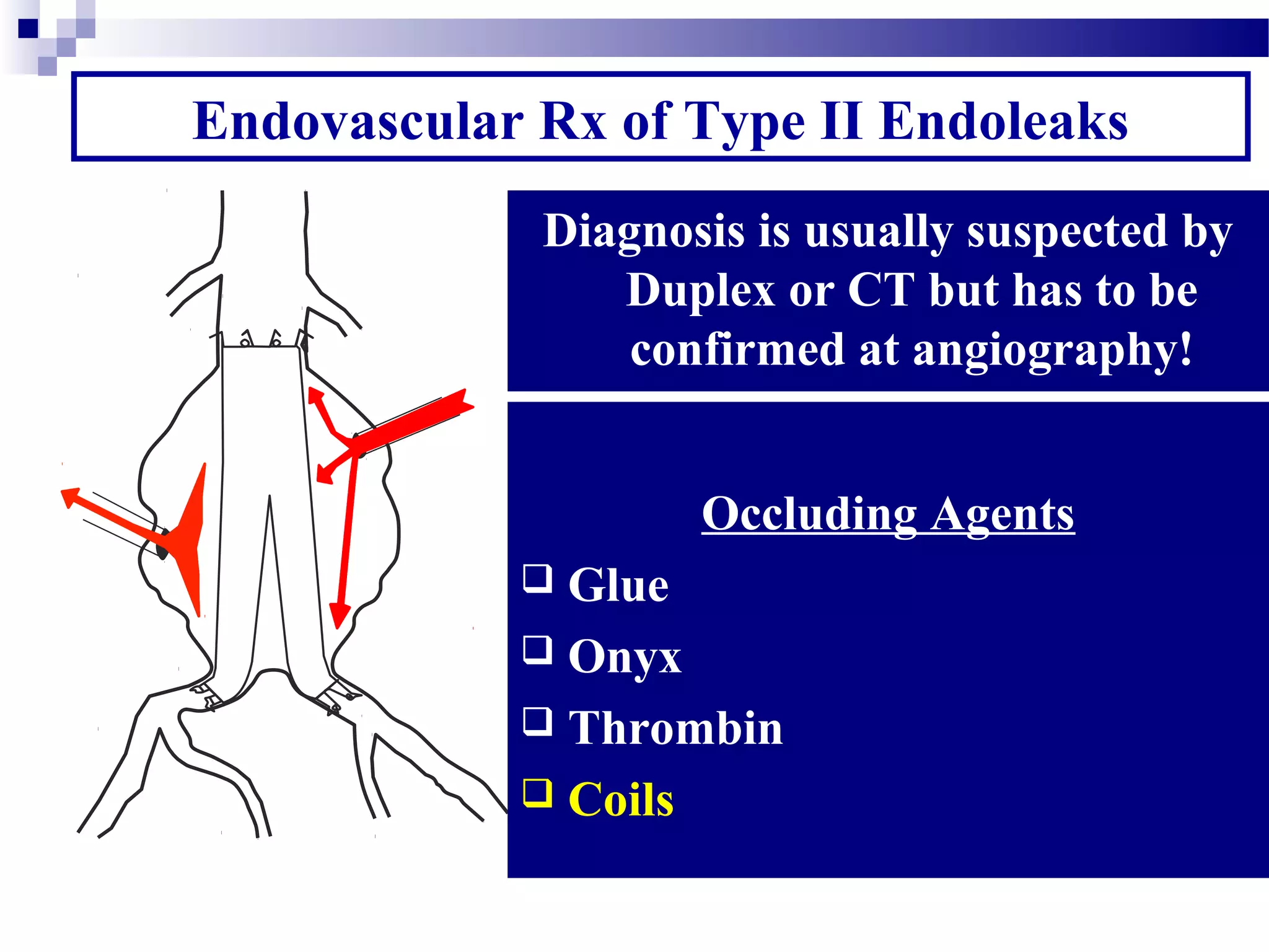 Endovascular Rx of Type II Endoleaks
Multiple Branch Vessels involved
 IMA
 Multiple sets of Lumbars
 Other branches
 Large Nidus
Diagnosis is usually suspected by
Duplex or CT but has to be
confirmed at angiography!
Principle of Endo RX
 Obliterate the feeding vessels
and if possible the nidus
Three Different Approaches
 Trans-Arterial catheterization:
More technically demanding but
potentially more effective
 Translumbar puncture
 Transcaval direct access
Rx Nidus. Difficult to get vessels
Occluding Agents
 Glue
 Onyx
 Thrombin
 Coils
 