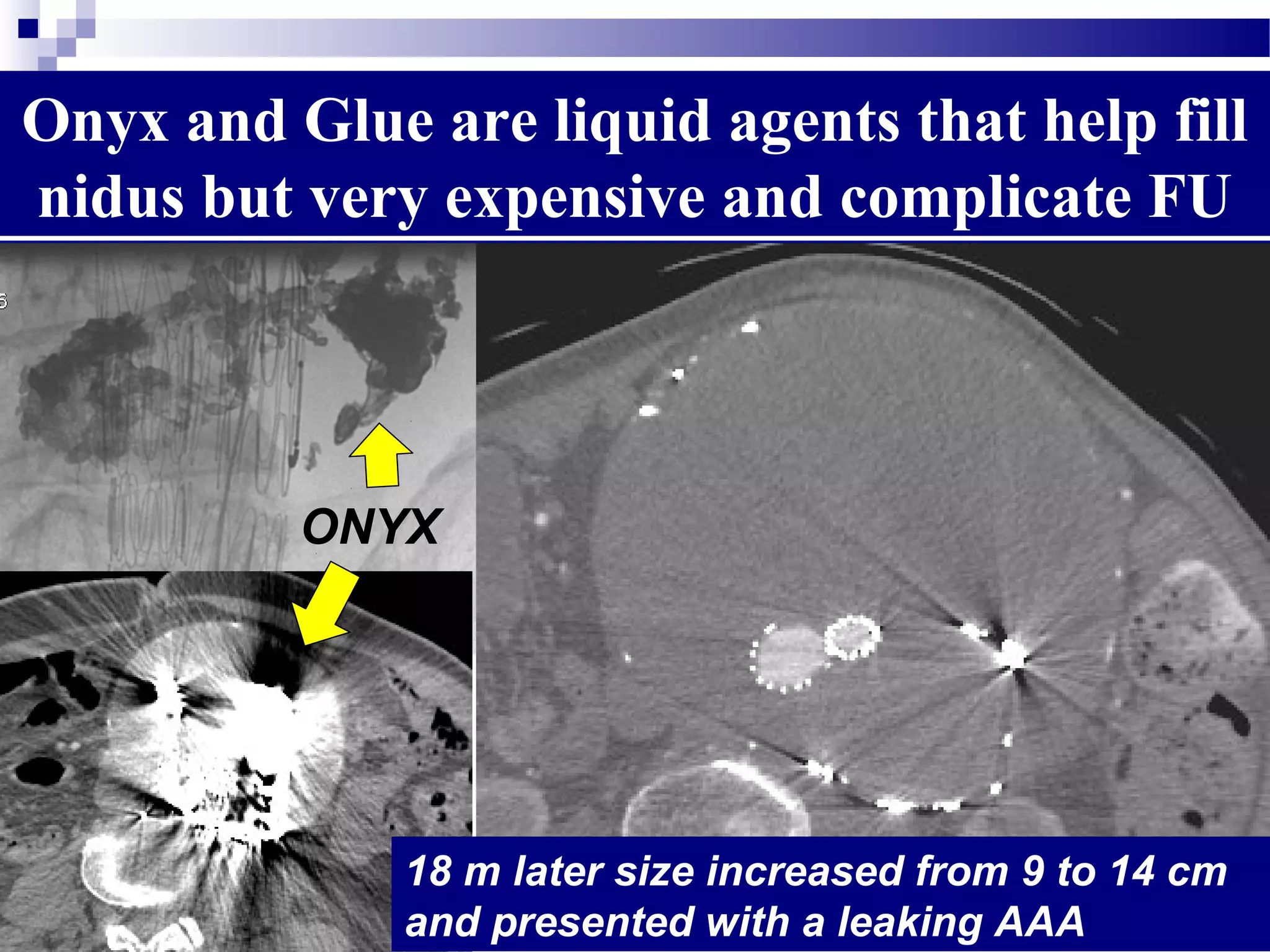 Onyx and Glue are liquid agents that help fill
nidus but very expensive and complicate FU
ONYX
18 m later size increased from 9 to 14 cm
and presented with a leaking AAA
 