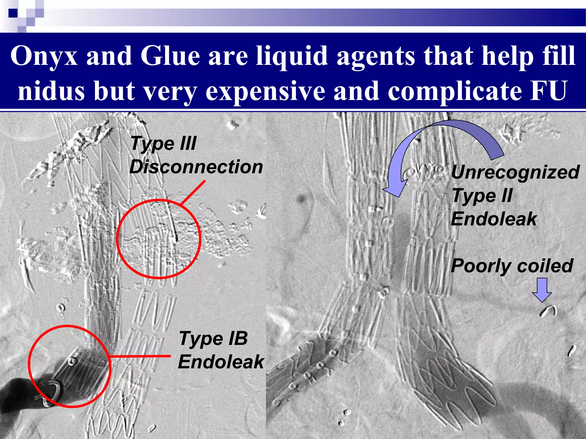 Onyx and Glue are liquid agents that help fill
nidus but very expensive and complicate FU
Type III
Disconnection
Type IB
Endoleak
Unrecognized
Type II
Endoleak
Poorly coiled
 