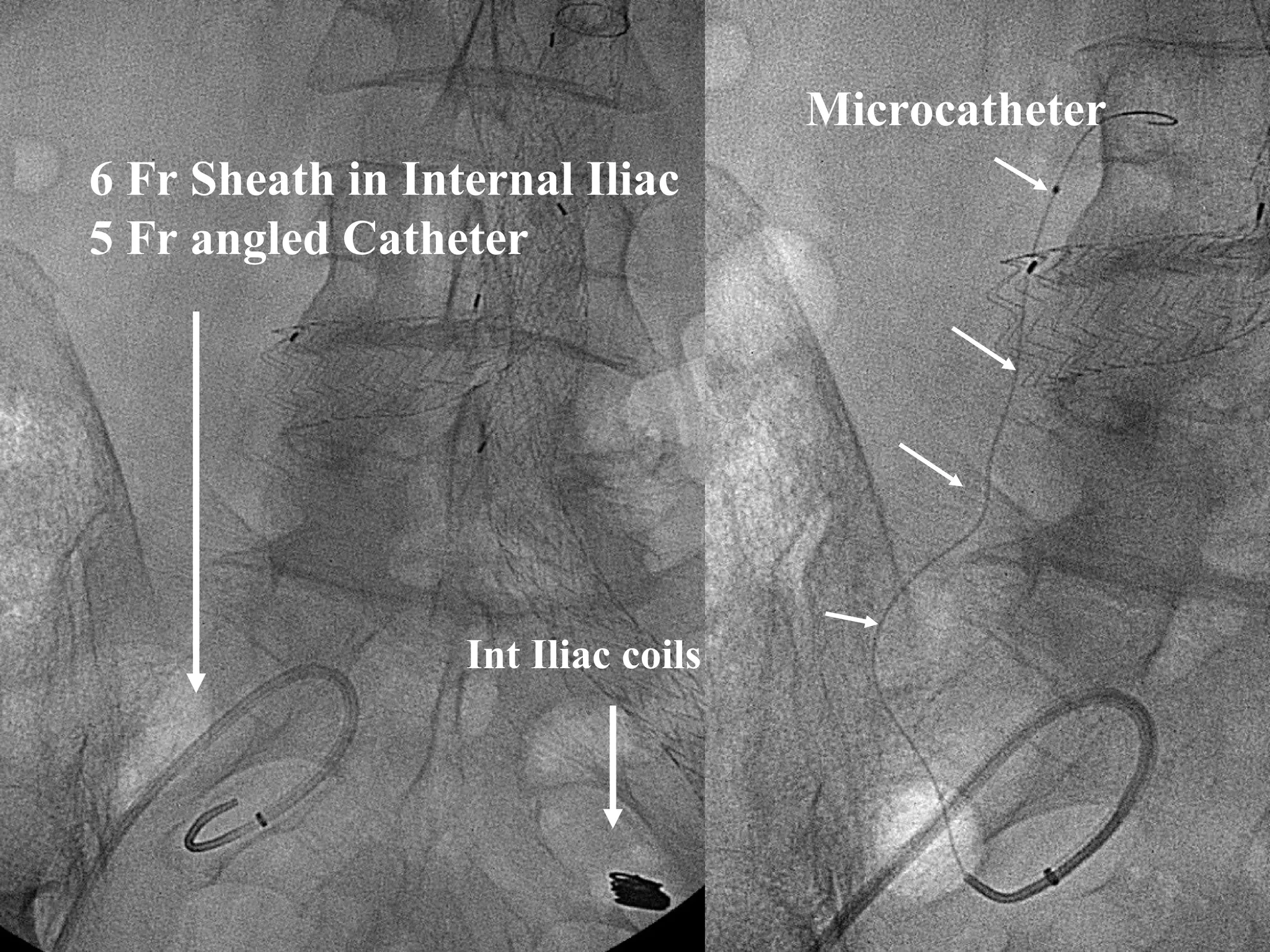 Int Iliac coils
6 Fr Sheath in Internal Iliac
5 Fr angled Catheter
Microcatheter
 