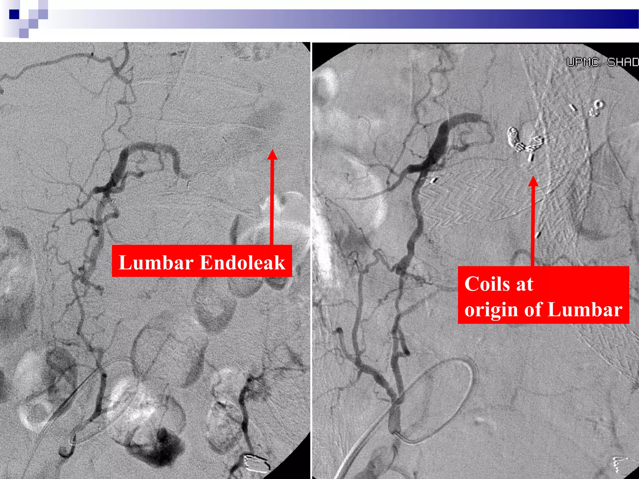 Lumbar Endoleak
Coils at
origin of Lumbar
 
