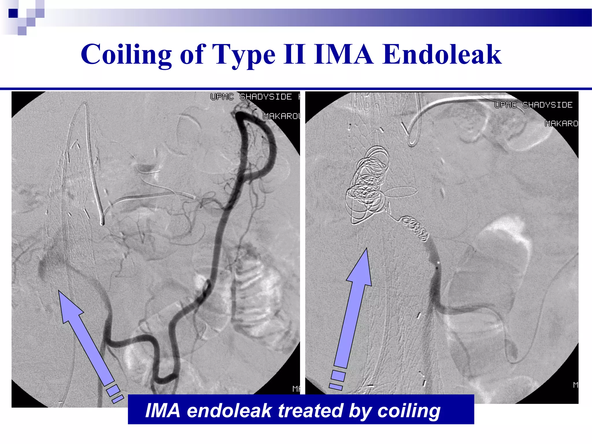 Coiling of Type II IMA Endoleak
IMA endoleak treated by coiling
 