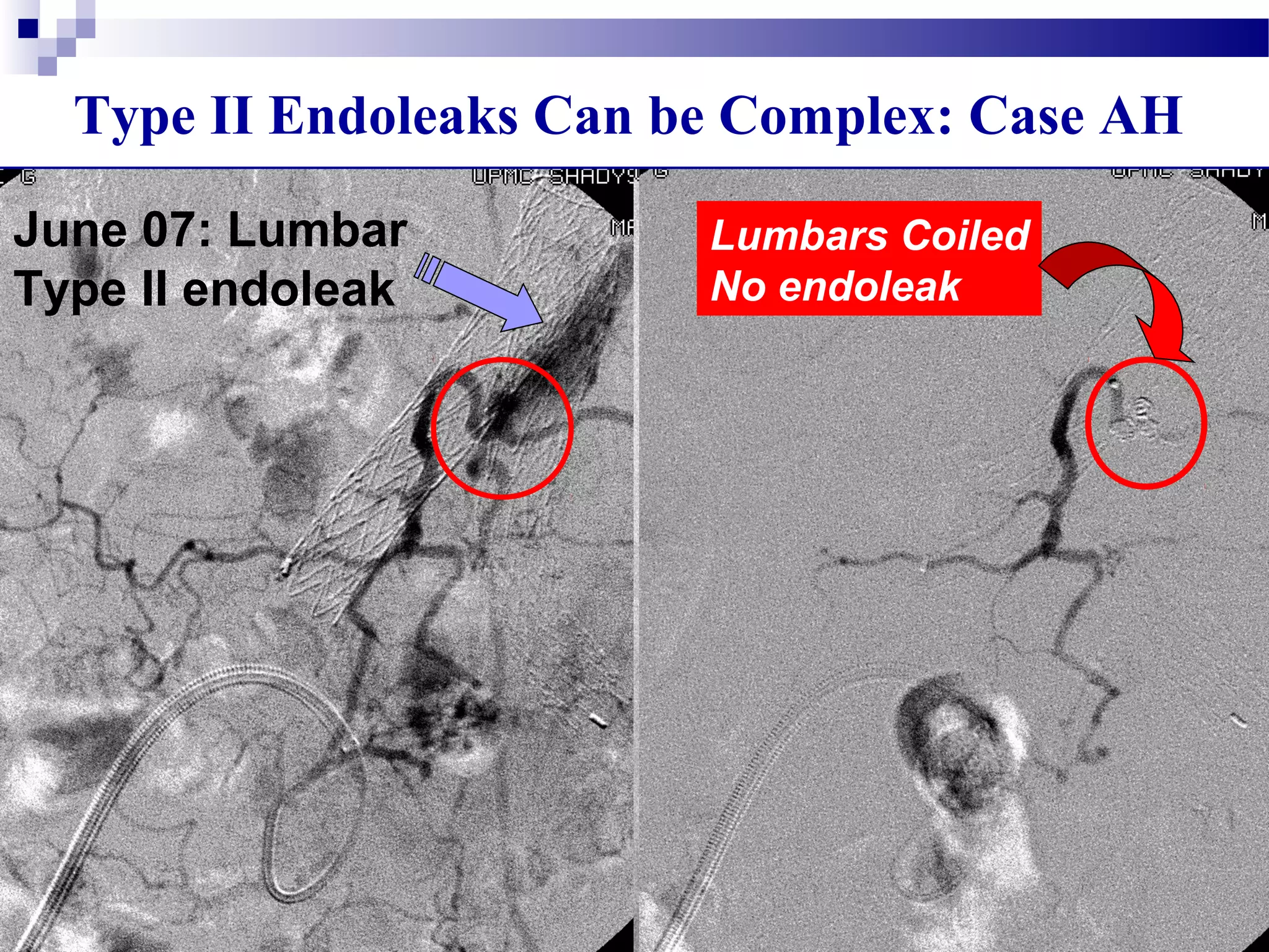 Type II Endoleaks Can be Complex: Case AH
June 07: Lumbar
Type II endoleak
Microcatheter
Access
Lumbars Coiled
No endoleak
 