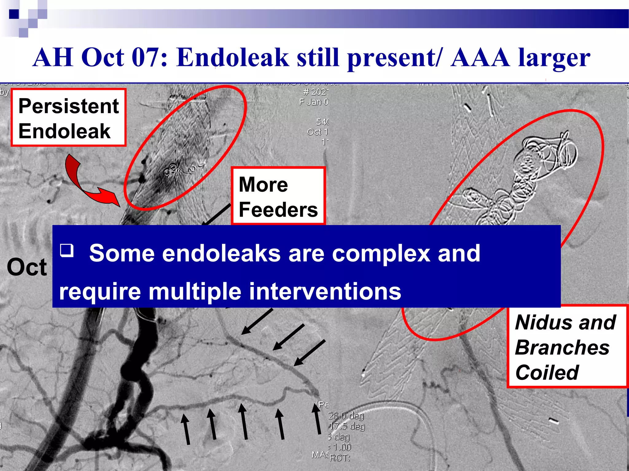 AH Oct 07: Endoleak still present/ AAA larger
Oct 07
Persistent
Endoleak
More
Feeders
Renegade
Micro
Catheter
Access to
AAA Sac
Complex Endoleak
Nidus and
Branches
Coiled
 Some endoleaks are complex and
require multiple interventions
 