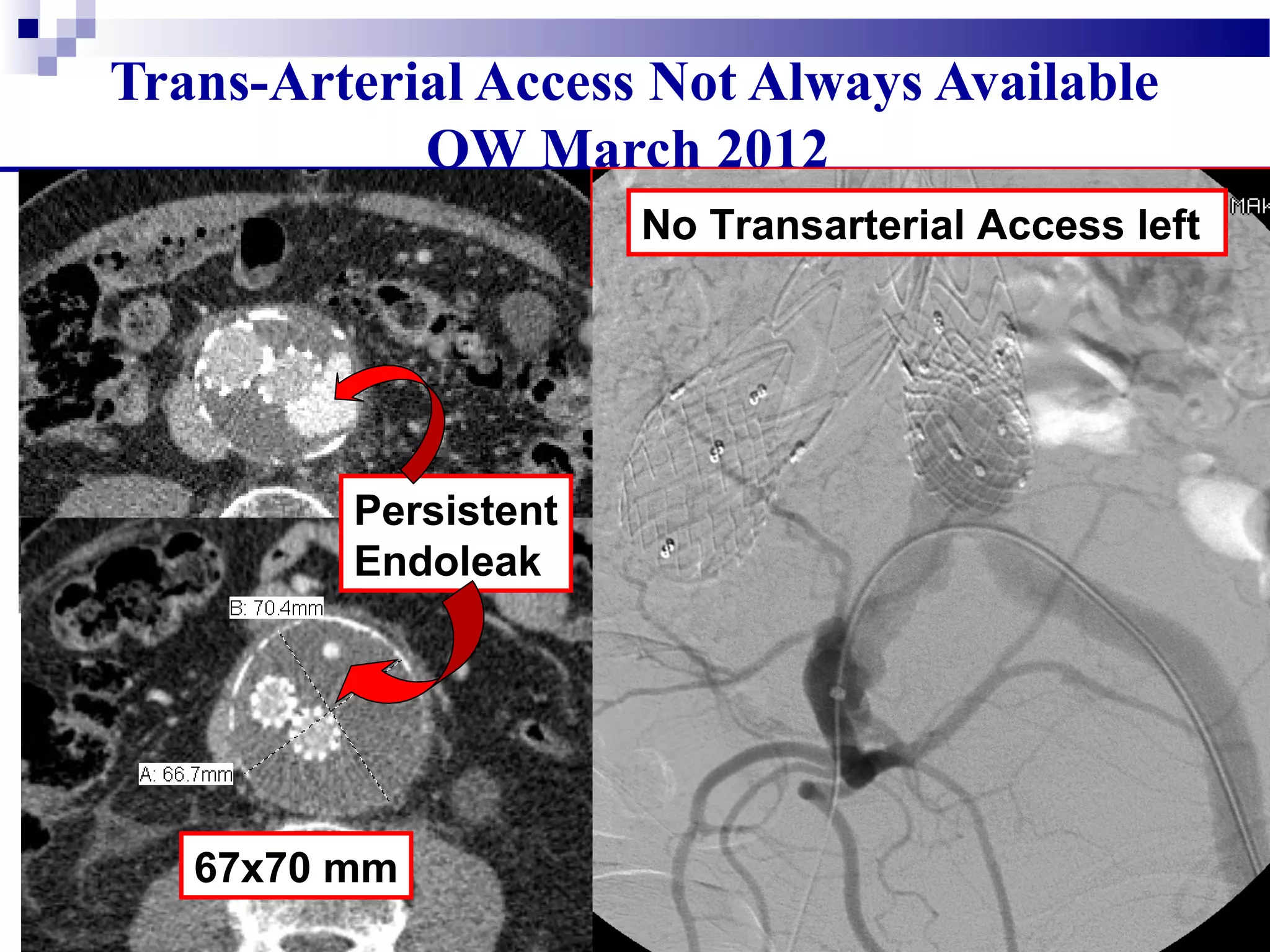 Trans-Arterial Access Not Always Available
OW March 2012
Persistent
Endoleak
67x70 mm
Type II Endoleak
No Transarterial Access Right
No Transarterial Access left
 