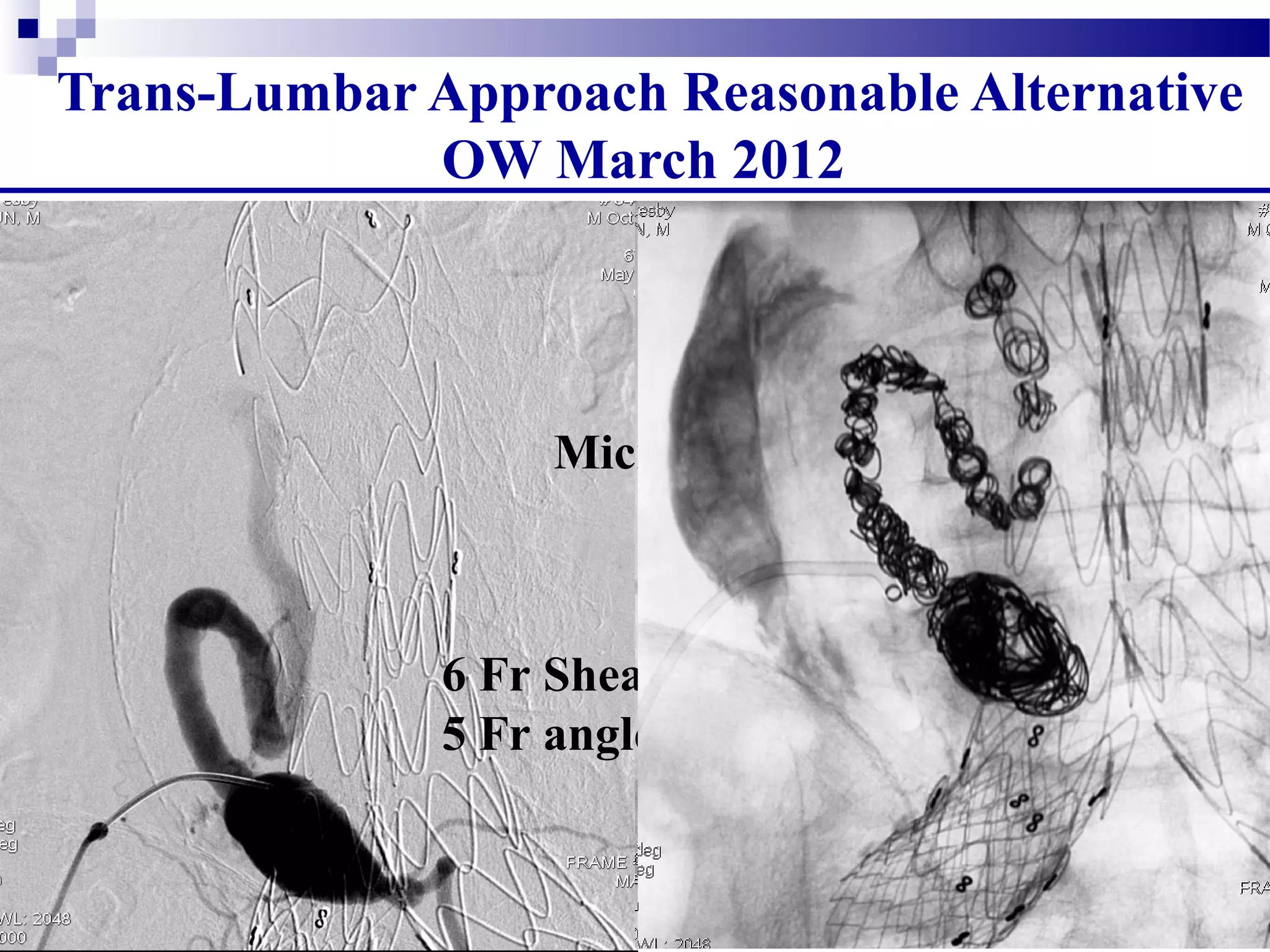 Trans-Lumbar Approach Reasonable Alternative
OW March 2012
6 Fr Sheath
5 Fr angled Catheter
Microcatheter
 