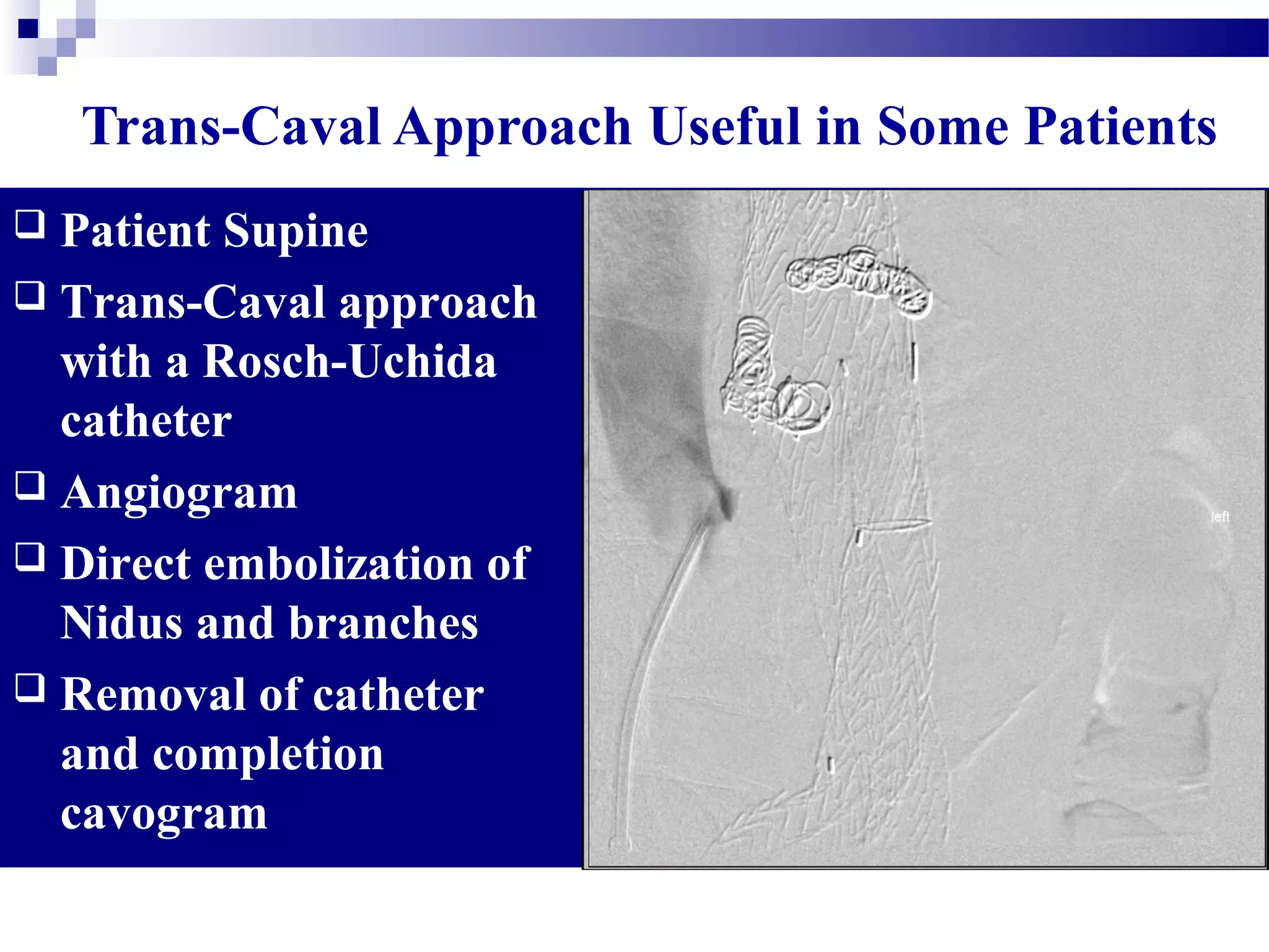 Trans-Caval Approach Useful in Some Patients
 Patient Supine
 Trans-Caval approach
with a Rosch-Uchida
catheter
 Angiogram
 Direct embolization of
Nidus and branches
 Removal of catheter
and completion
cavogram
 