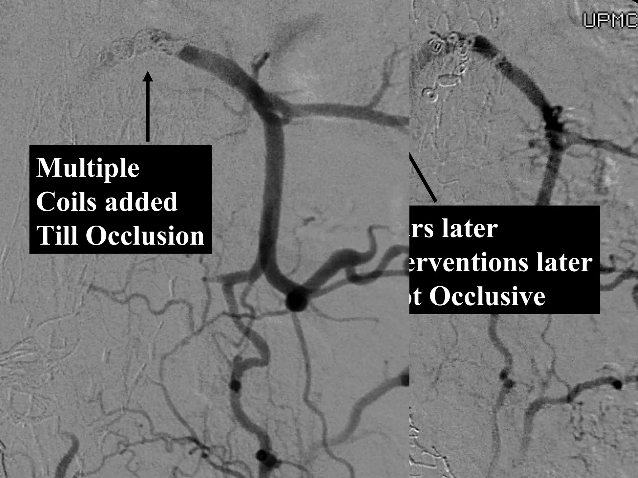 3 Lumbar Coils
Two years later
Two interventions later
Coils Not Occlusive
Multiple
Coils added
Till Occlusion
 