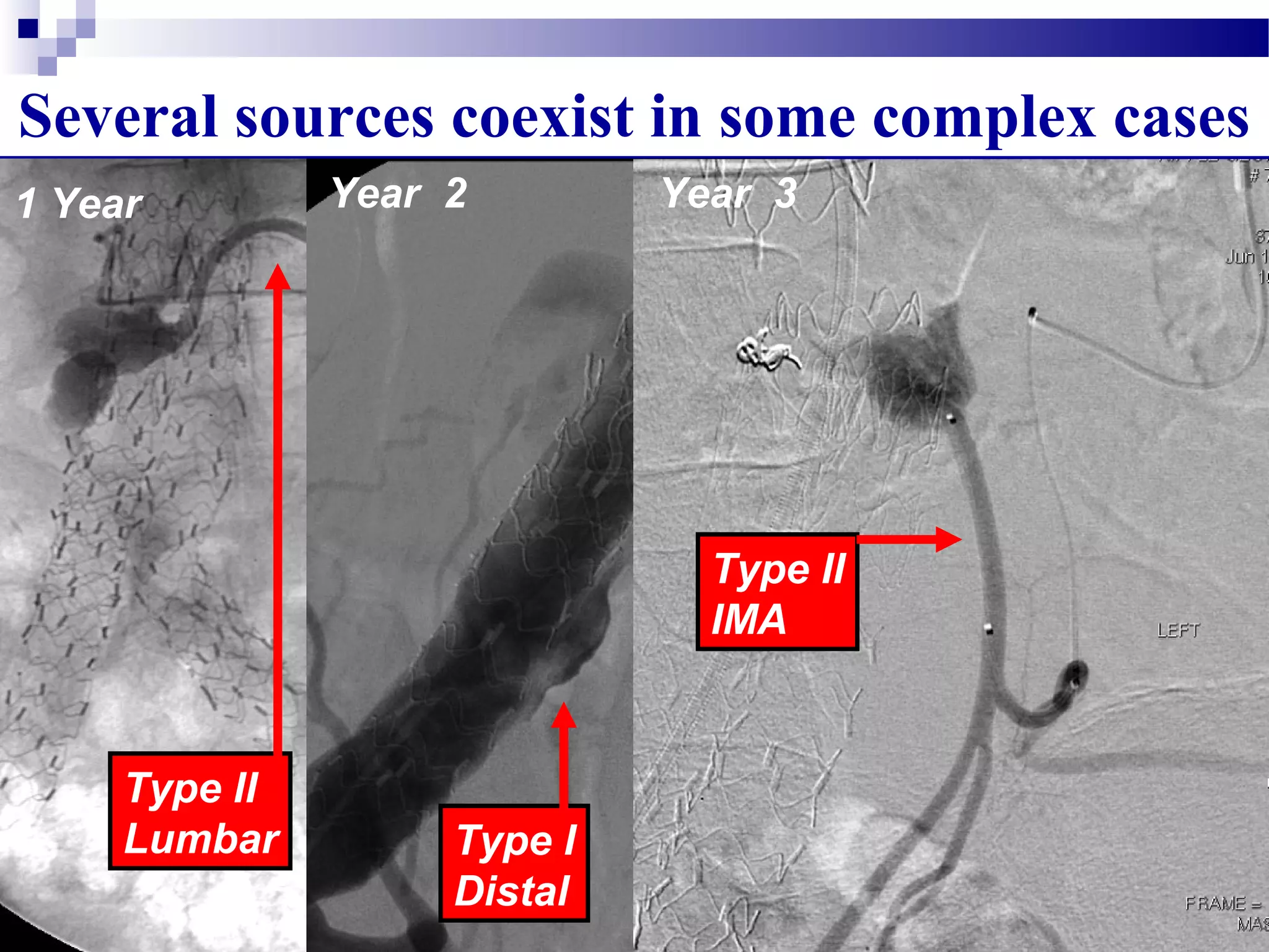 Several sources coexist in some complex cases
Type II
Lumbar
1 Year Year 2
Type I
Distal
Year 3
Type II
IMA
 