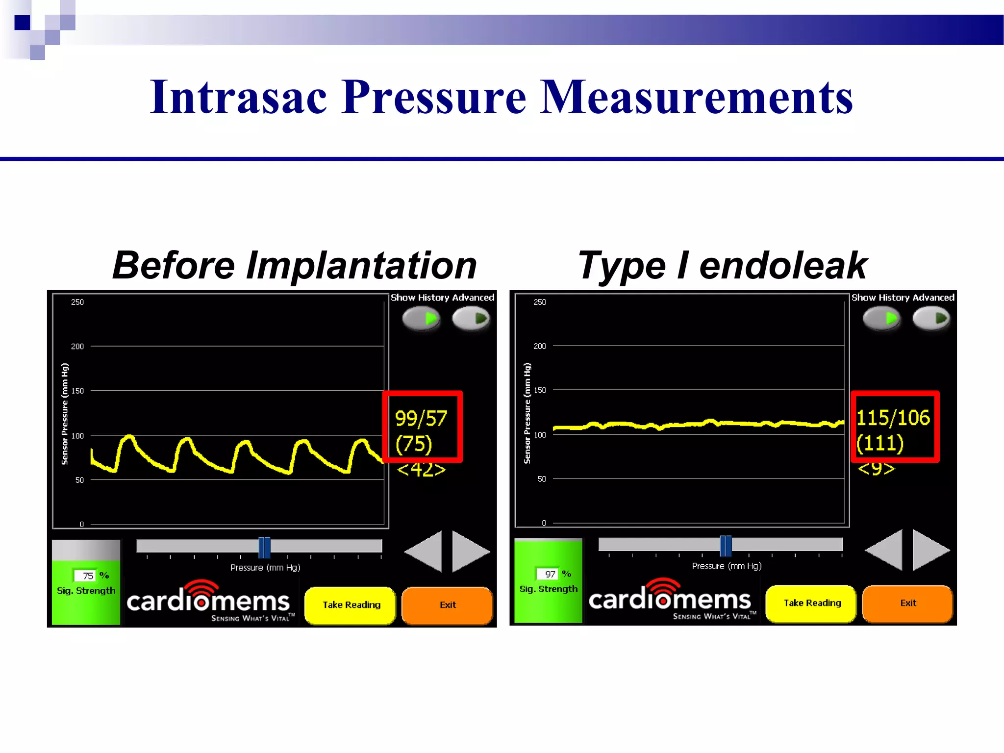 Intrasac Pressure Measurements
Before Exclusion
Mean Pressure: 75 mmHg
After EVAR with Type I
Mean Pressure: 111 mmHgBefore Implantation Type I endoleak
 