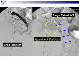 Enigma Injection Management of endoleaks after evar asvs 2013 | PPT