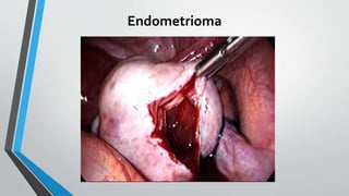 Endometrioma
 