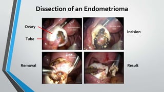 Dissection of an Endometrioma
Tube
Ovary
Incision
Removal Result
 