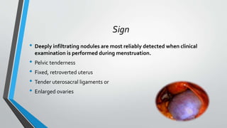 Sign
• Deeply infiltrating nodules are most reliably detected when clinical
examination is performed during menstruation.
• Pelvic tenderness
• Fixed, retroverted uterus
• Tender uterosacral ligaments or
• Enlarged ovaries
 
