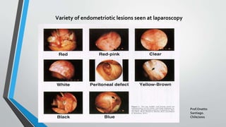 Variety of endometriotic lesions seen at laparoscopy
Prof.Onetto
Santiago.
Chile/2001
 