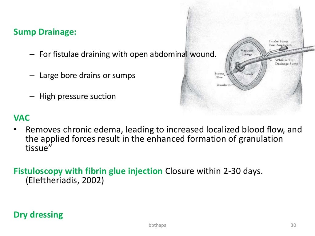 Management of enterocutaneous fistula