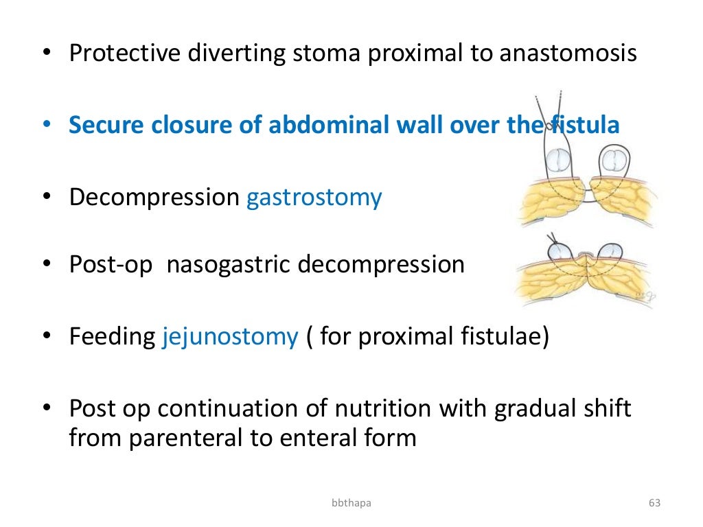 Management of enterocutaneous fistula