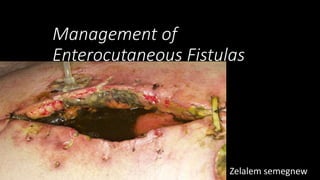 Management of
Enterocutaneous Fistulas
Zelalem semegnewJH0905050
 