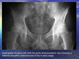 Radiograph of pelvis with both hip joints anteroposterior view showing a
bilateral idiopathic osteonecrosis of hip in earl...