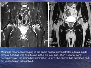 Magnetic resonance imaging of the same patient demonstrates edema inside
femoral head as well as effusion in the hip joint...