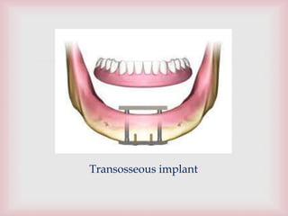 
Transosseous implant
 