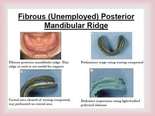 False Ridges flat ridge management .pptx