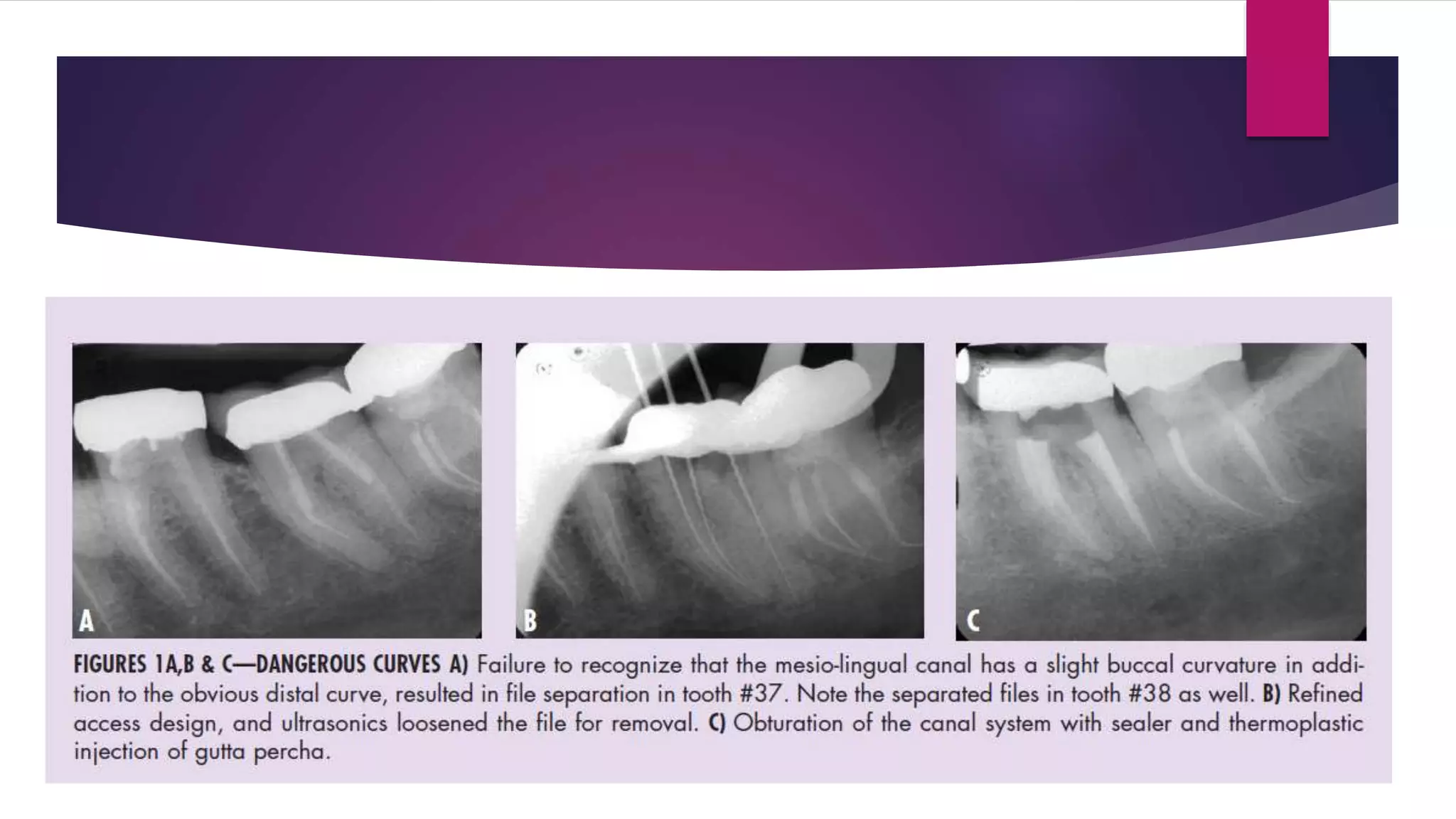 Management of fractured endodontic instruments in root canal | PPTX