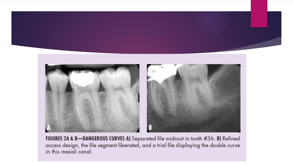 Management of fractured endodontic instruments in root canal