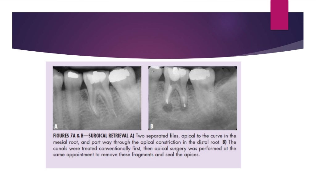 Management of fractured endodontic instruments in root canal