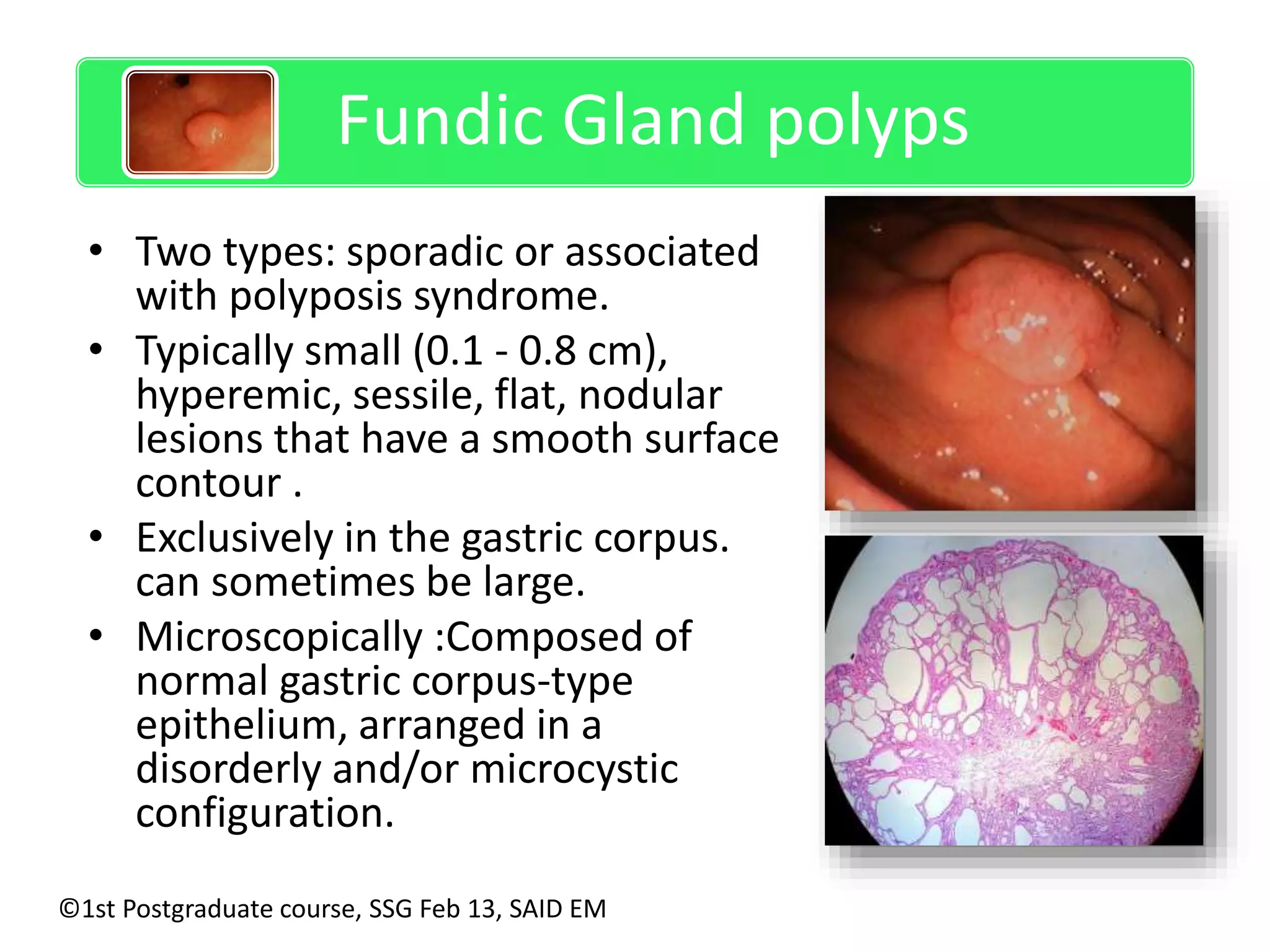 Sporadic Fundic gland polyps 
Fundic Gland polyps 
• Two types: sporadic or associated 
with polyposis syndrome. 
• Typically small (0.1 - 0.8 cm), 
hyperemic, sessile, flat, nodular 
lesions that have a smooth surface 
contour . 
• Exclusively in the gastric corpus. 
can sometimes be large. 
• Microscopically :Composed of 
normal gastric corpus-type 
epithelium, arranged in a 
disorderly and/or microcystic 
configuration. 
©1st Postgraduate course, SSG Feb 13, SAID EM 
 