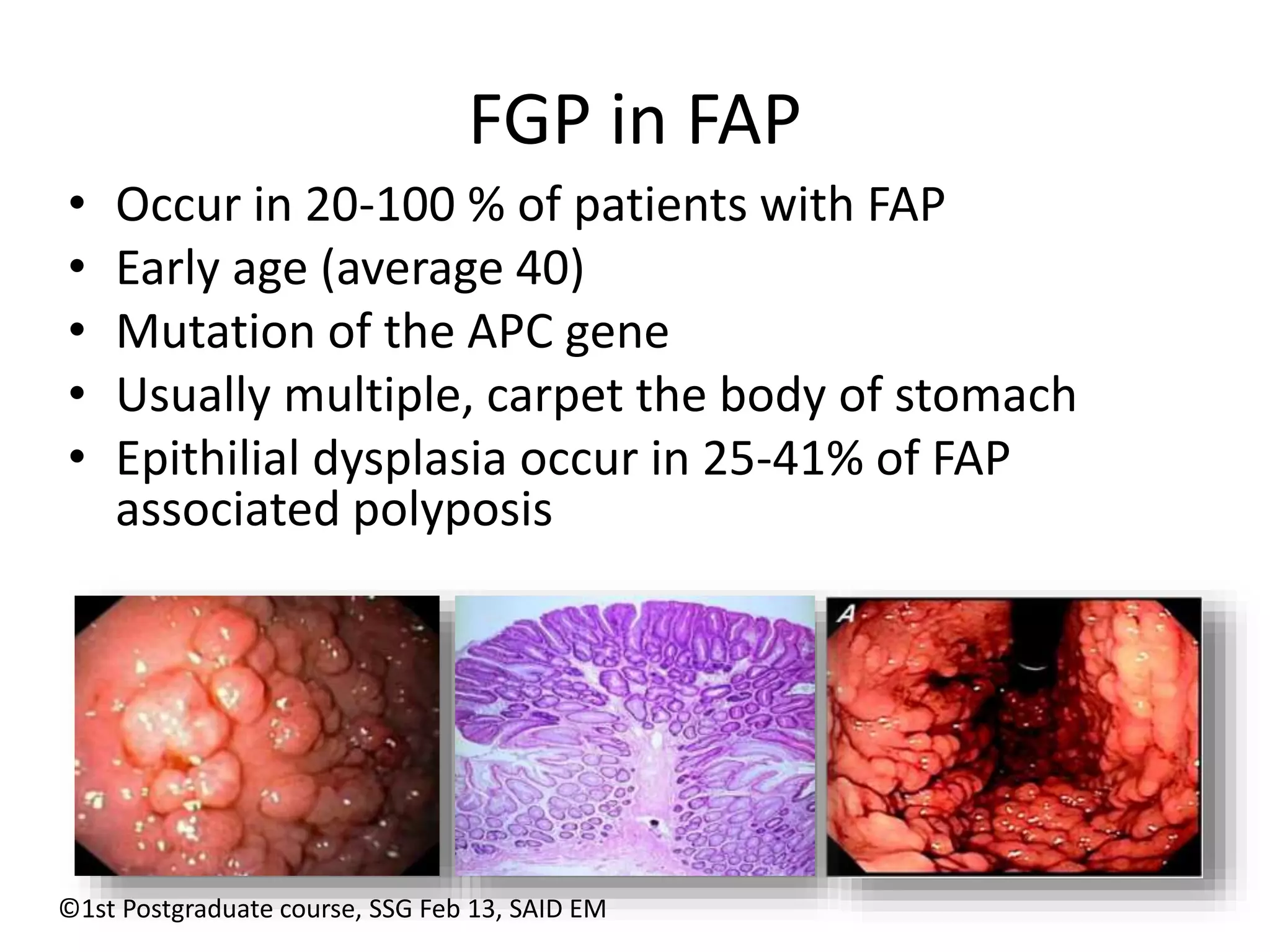 FGP in FAP 
• Occur in 20-100 % of patients with FAP 
• Early age (average 40) 
• Mutation of the APC gene 
• Usually multiple, carpet the body of stomach 
• Epithilial dysplasia occur in 25-41% of FAP 
associated polyposis 
©1st Postgraduate course, SSG Feb 13, SAID EM 
 