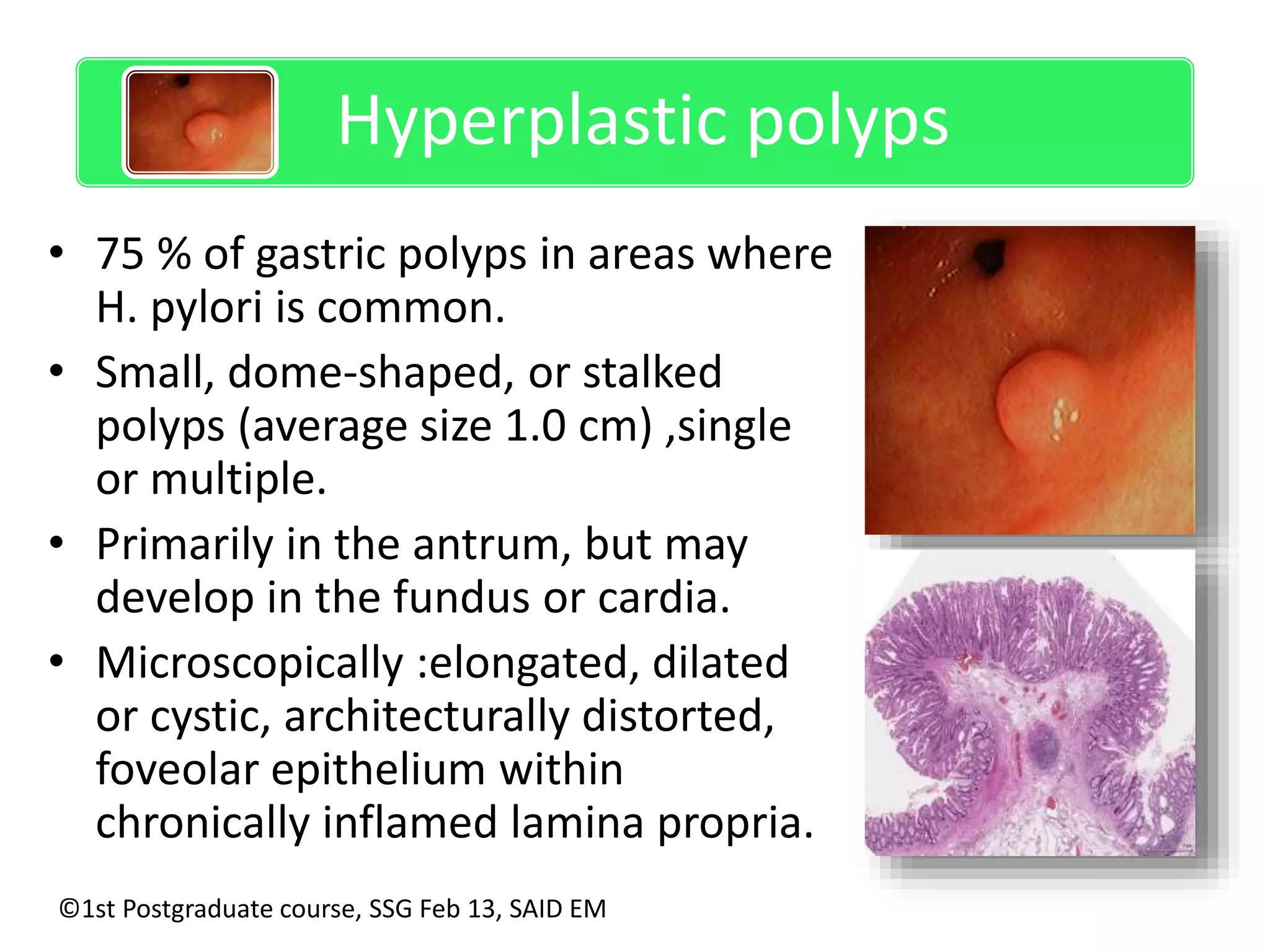 Hyperplastic polyps 
• 75 % of gastric polyps in areas where 
H. pylori is common. 
• Small, dome-shaped, or stalked 
polyps (average size 1.0 cm) ,single 
or multiple. 
• Primarily in the antrum, but may 
develop in the fundus or cardia. 
• Microscopically :elongated, dilated 
or cystic, architecturally distorted, 
foveolar epithelium within 
chronically inflamed lamina propria. 
©1st Postgraduate course, SSG Feb 13, SAID EM 
 