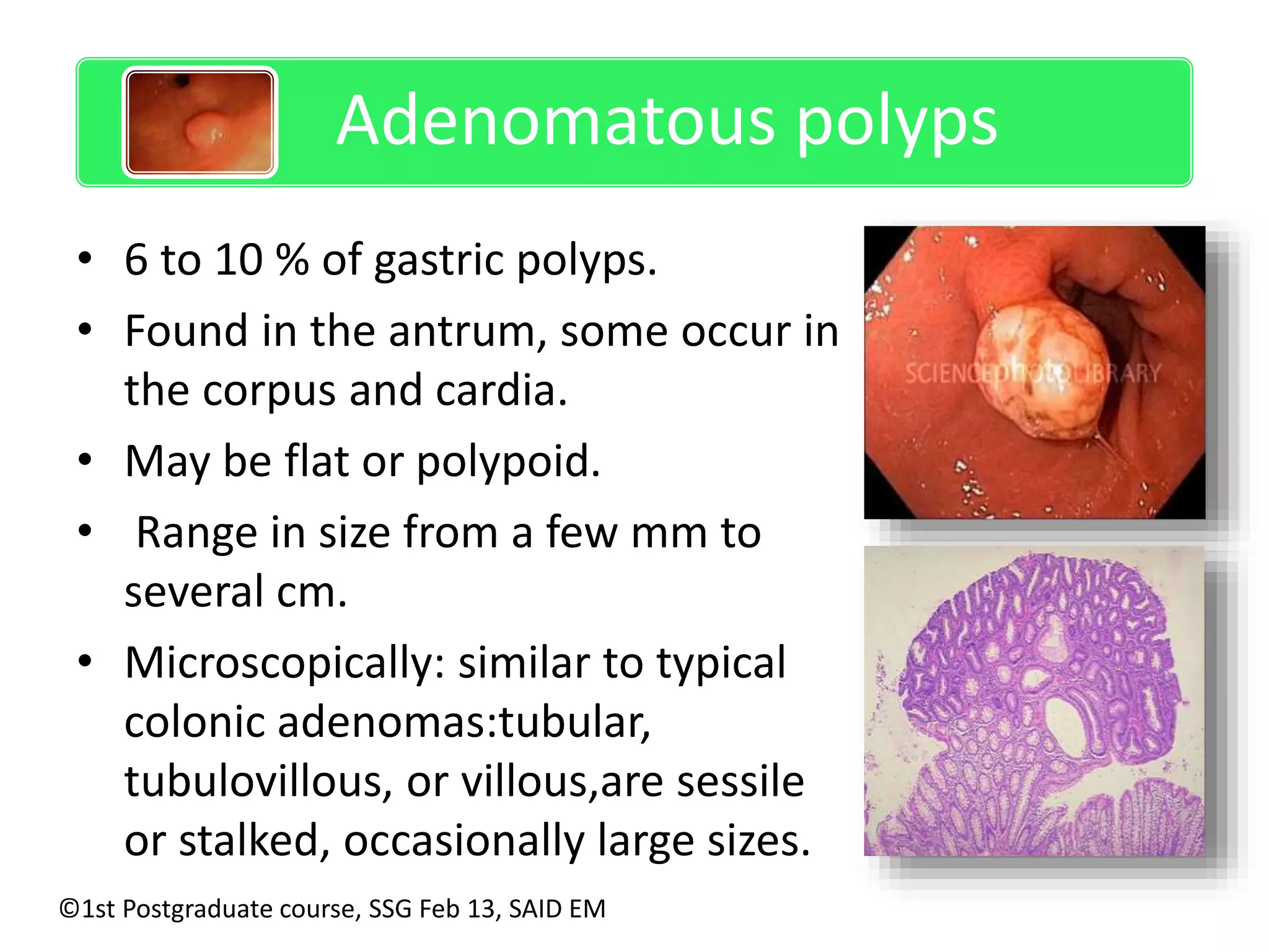 Adenomatous polyps 
• 6 to 10 % of gastric polyps. 
• Found in the antrum, some occur in 
the corpus and cardia. 
• May be flat or polypoid. 
• Range in size from a few mm to 
several cm. 
• Microscopically: similar to typical 
colonic adenomas:tubular, 
tubulovillous, or villous,are sessile 
or stalked, occasionally large sizes. 
©1st Postgraduate course, SSG Feb 13, SAID EM 
 