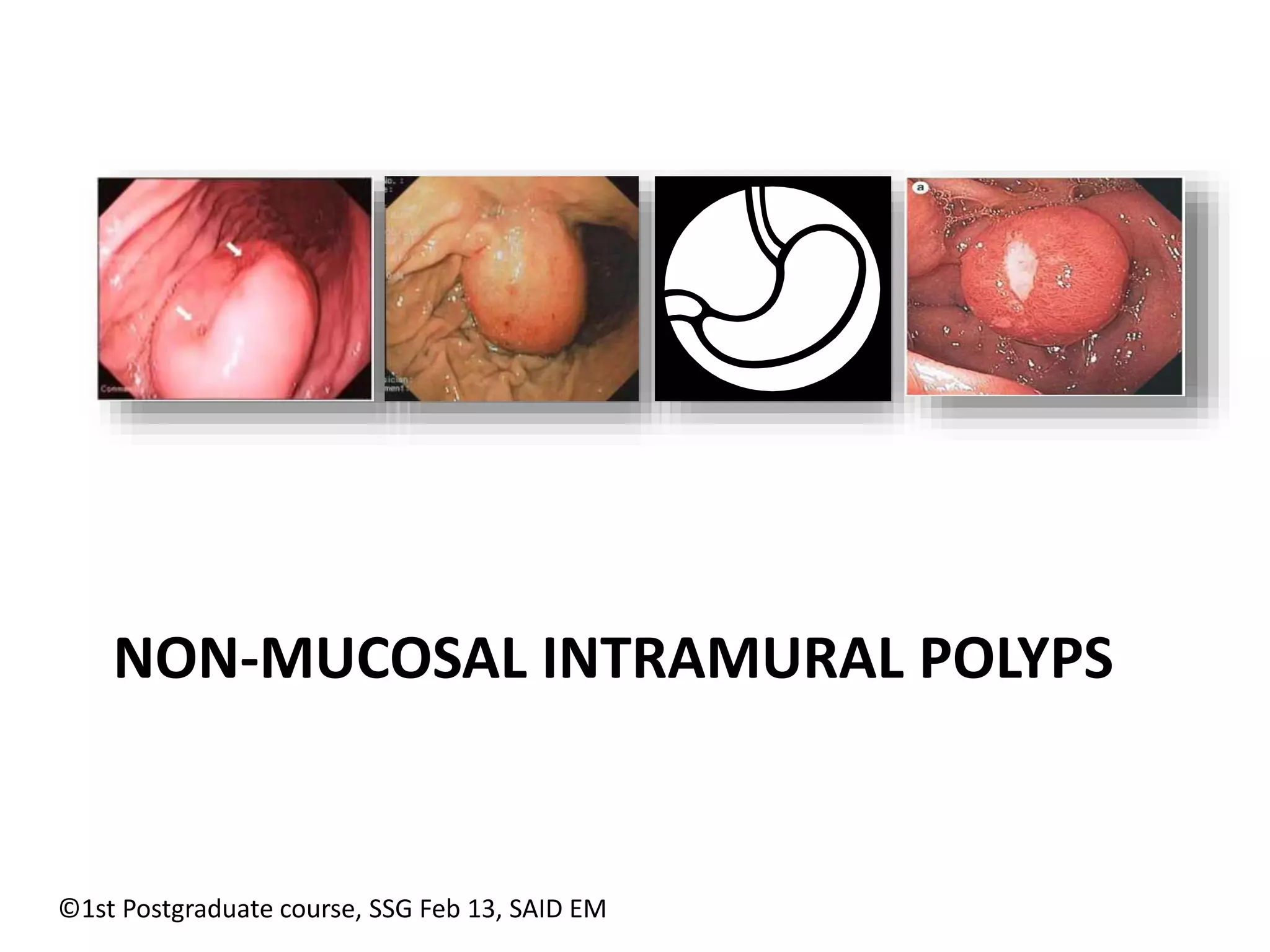 NON-MUCOSAL INTRAMURAL POLYPS 
©1st Postgraduate course, SSG Feb 13, SAID EM 
 