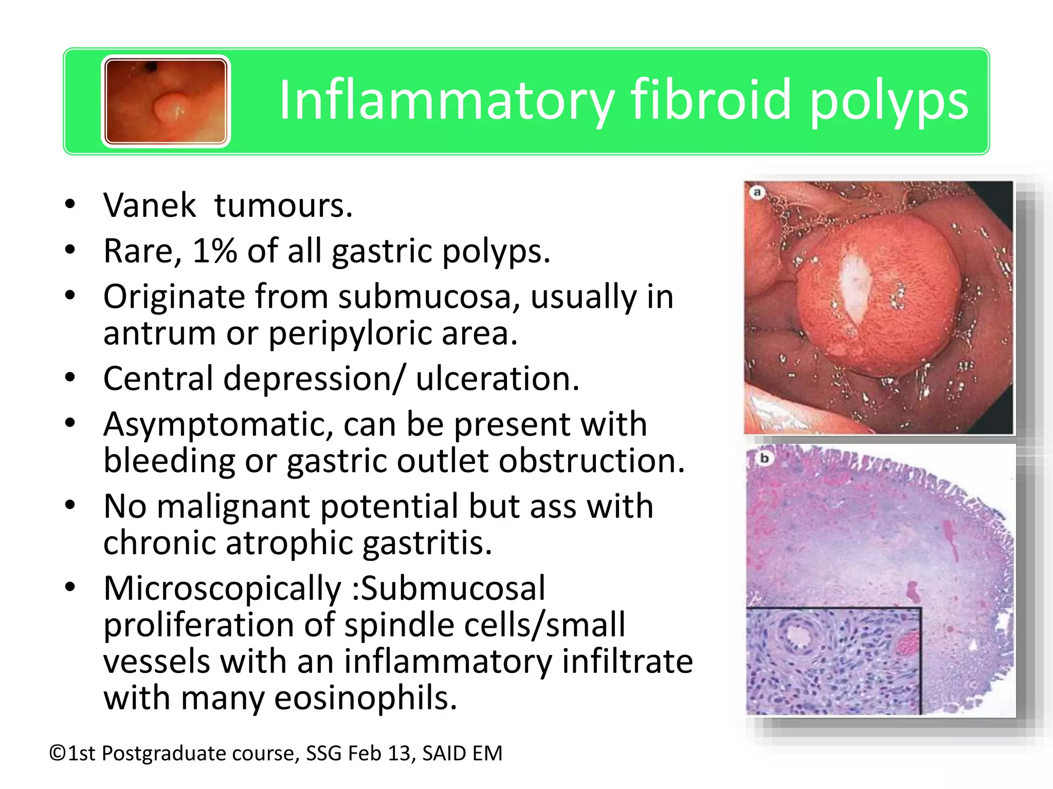 Inflammatory fibroid polyps 
• Vanek tumours. 
• Rare, 1% of all gastric polyps. 
• Originate from submucosa, usually in 
antrum or peripyloric area. 
• Central depression/ ulceration. 
• Asymptomatic, can be present with 
bleeding or gastric outlet obstruction. 
• No malignant potential but ass with 
chronic atrophic gastritis. 
• Microscopically :Submucosal 
proliferation of spindle cells/small 
vessels with an inflammatory infiltrate 
with many eosinophils. 
©1st Postgraduate course, SSG Feb 13, SAID EM 
 