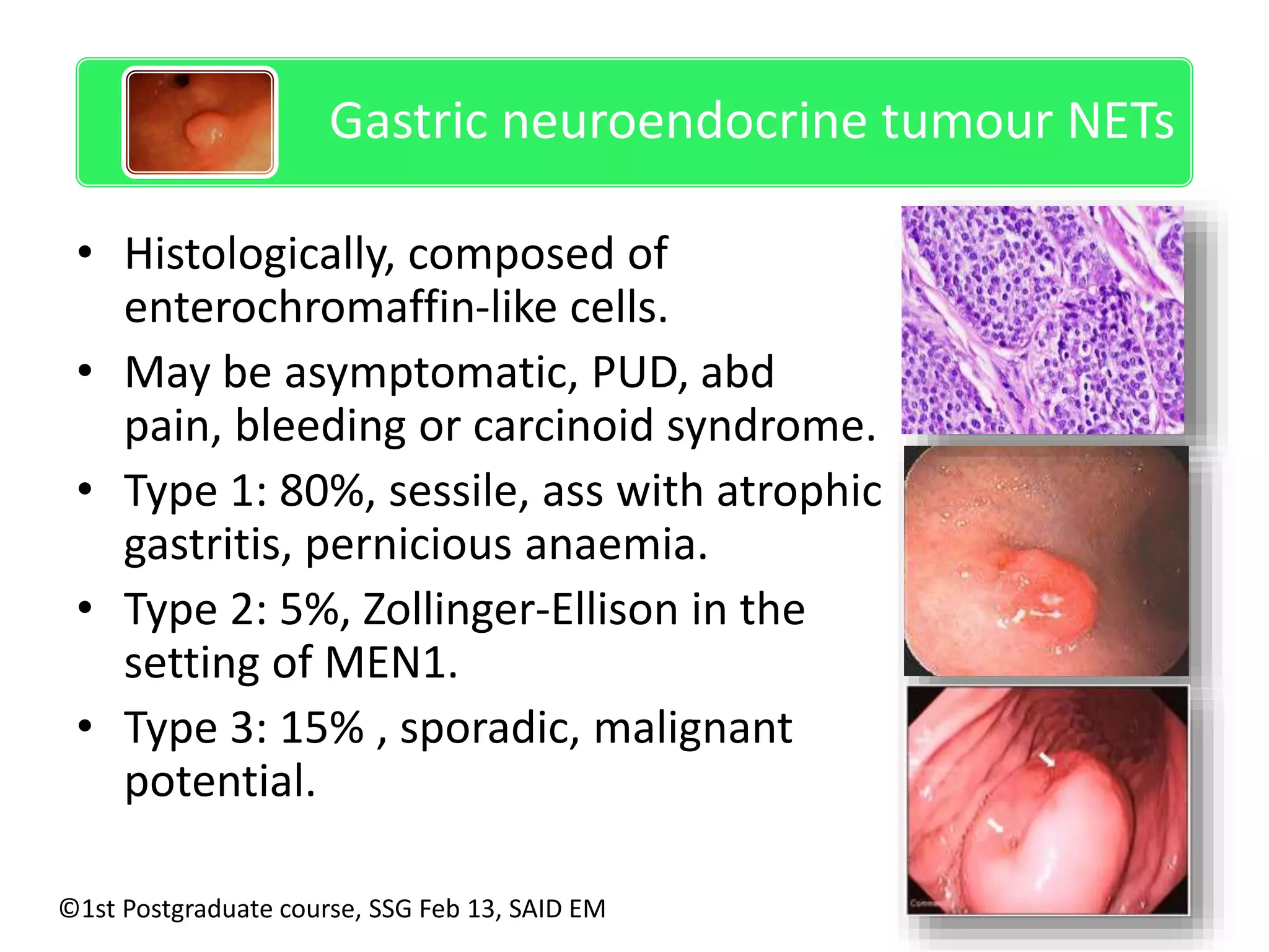 Gastric neuroendocrine tumour NETs 
• Histologically, composed of 
enterochromaffin-like cells. 
• May be asymptomatic, PUD, abd 
pain, bleeding or carcinoid syndrome. 
• Type 1: 80%, sessile, ass with atrophic 
gastritis, pernicious anaemia. 
• Type 2: 5%, Zollinger-Ellison in the 
setting of MEN1. 
• Type 3: 15% , sporadic, malignant 
potential. 
©1st Postgraduate course, SSG Feb 13, SAID EM 
 