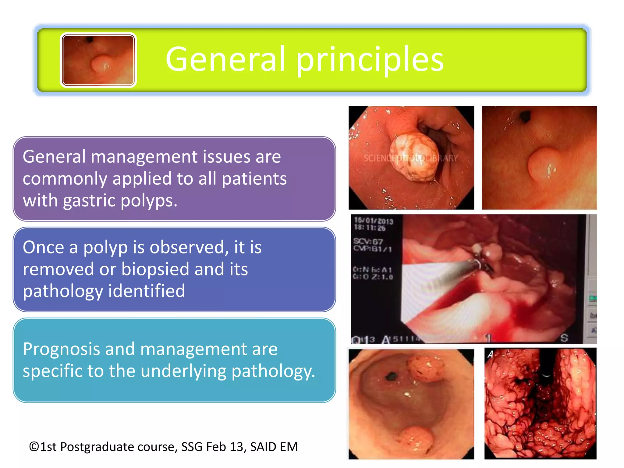 General principles 
General management issues are 
commonly applied to all patients 
with gastric polyps. 
Once a polyp is observed, it is 
removed or biopsied and its 
pathology identified 
Prognosis and management are 
specific to the underlying pathology. 
©1st Postgraduate course, SSG Feb 13, SAID EM 
 