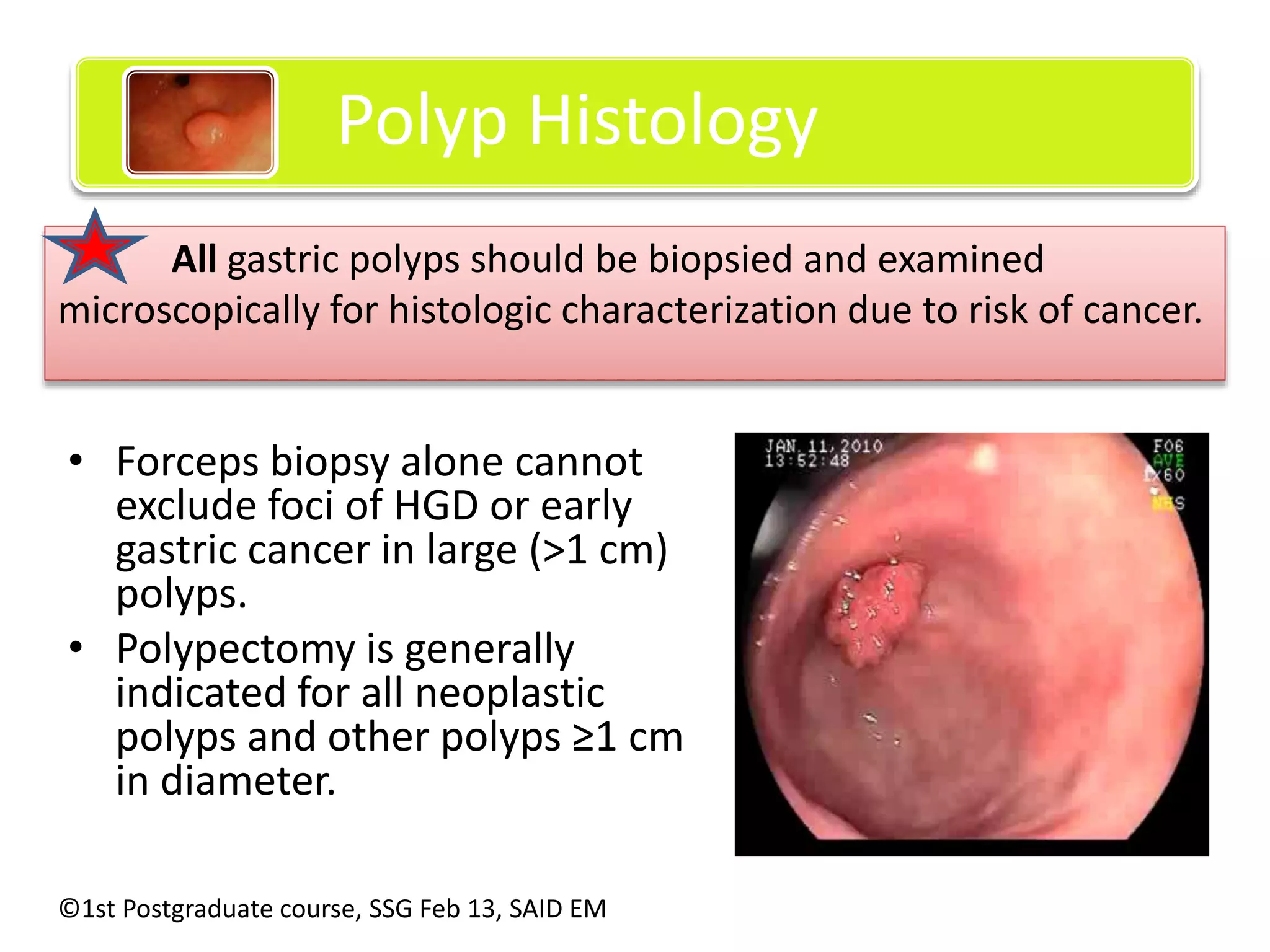 Polyp Histology 
All gastric polyps should be biopsied and examined 
microscopically for histologic characterization due to risk of cancer. 
• Forceps biopsy alone cannot 
exclude foci of HGD or early 
gastric cancer in large (>1 cm) 
polyps. 
• Polypectomy is generally 
indicated for all neoplastic 
polyps and other polyps ≥1 cm 
in diameter. 
©1st Postgraduate course, SSG Feb 13, SAID EM 
 