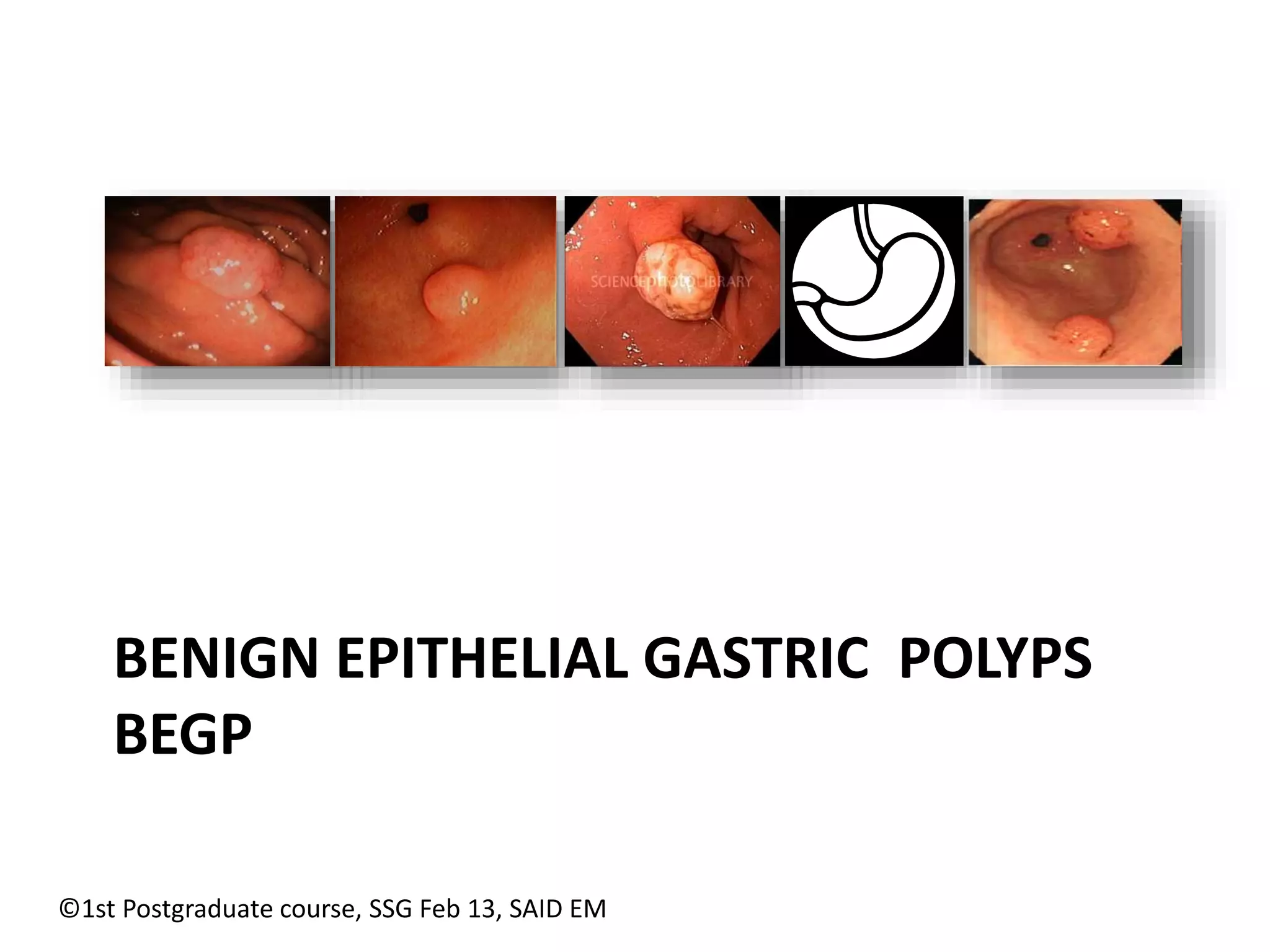 BENIGN EPITHELIAL GASTRIC POLYPS 
BEGP 
©1st Postgraduate course, SSG Feb 13, SAID EM 
 