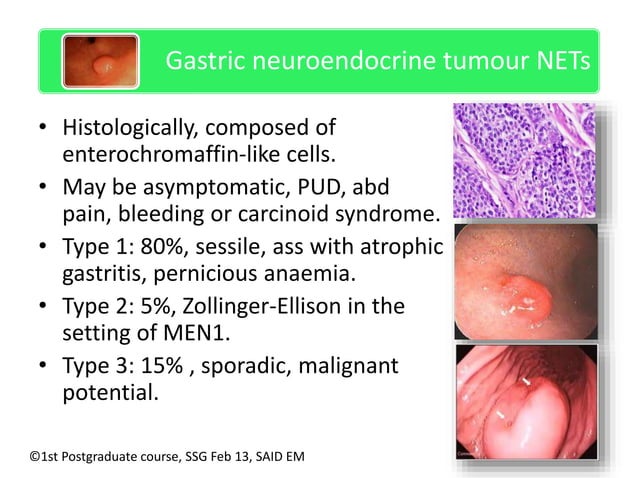 Management of gastric polyps | PPTX