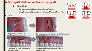 MANAGEMENT OF GINGIVAL RECESSION BY DR.HEMRAJ PANDIT.pptx