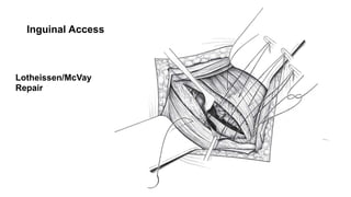 Mcvay Incision Management of Groin and Abdominal Wall Hernias.pptx